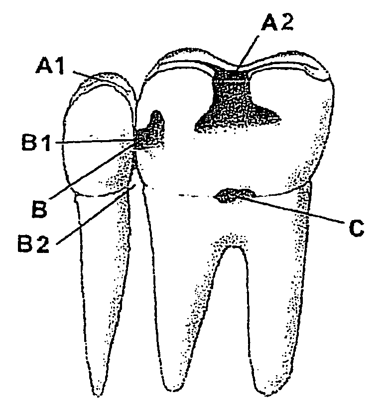 System for the controlled delivery of an active material to a dental site