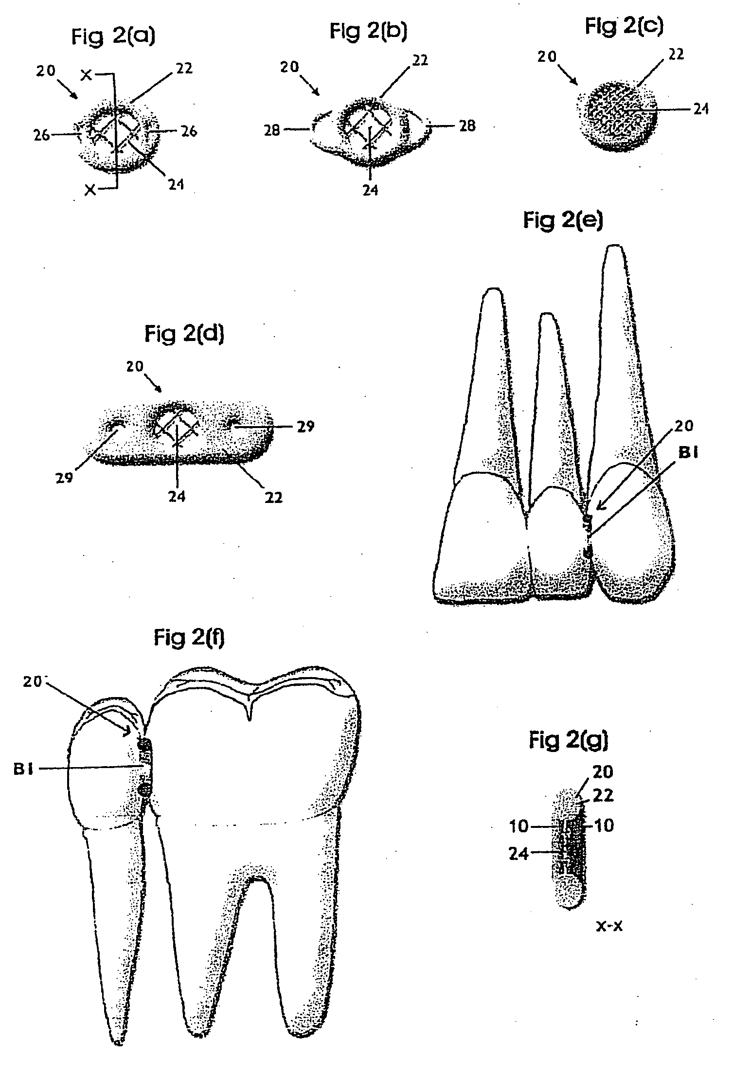 System for the controlled delivery of an active material to a dental site
