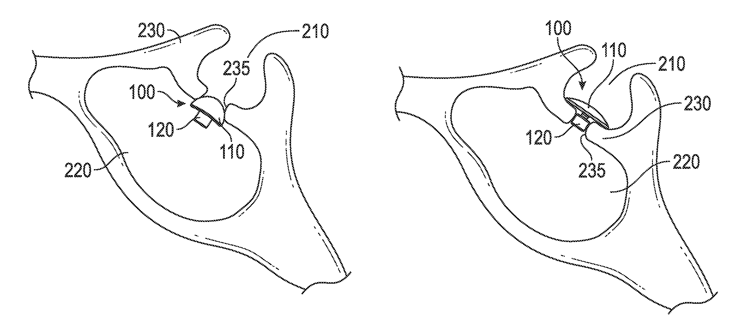 Cranial base implant device