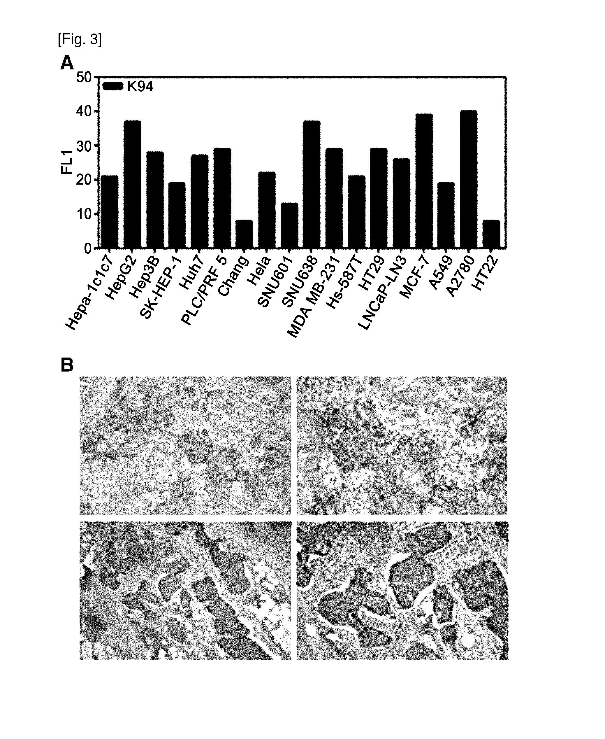 Marker comprising Anti-ck8/18 complex autoantibody and its use for diagnosing cancer