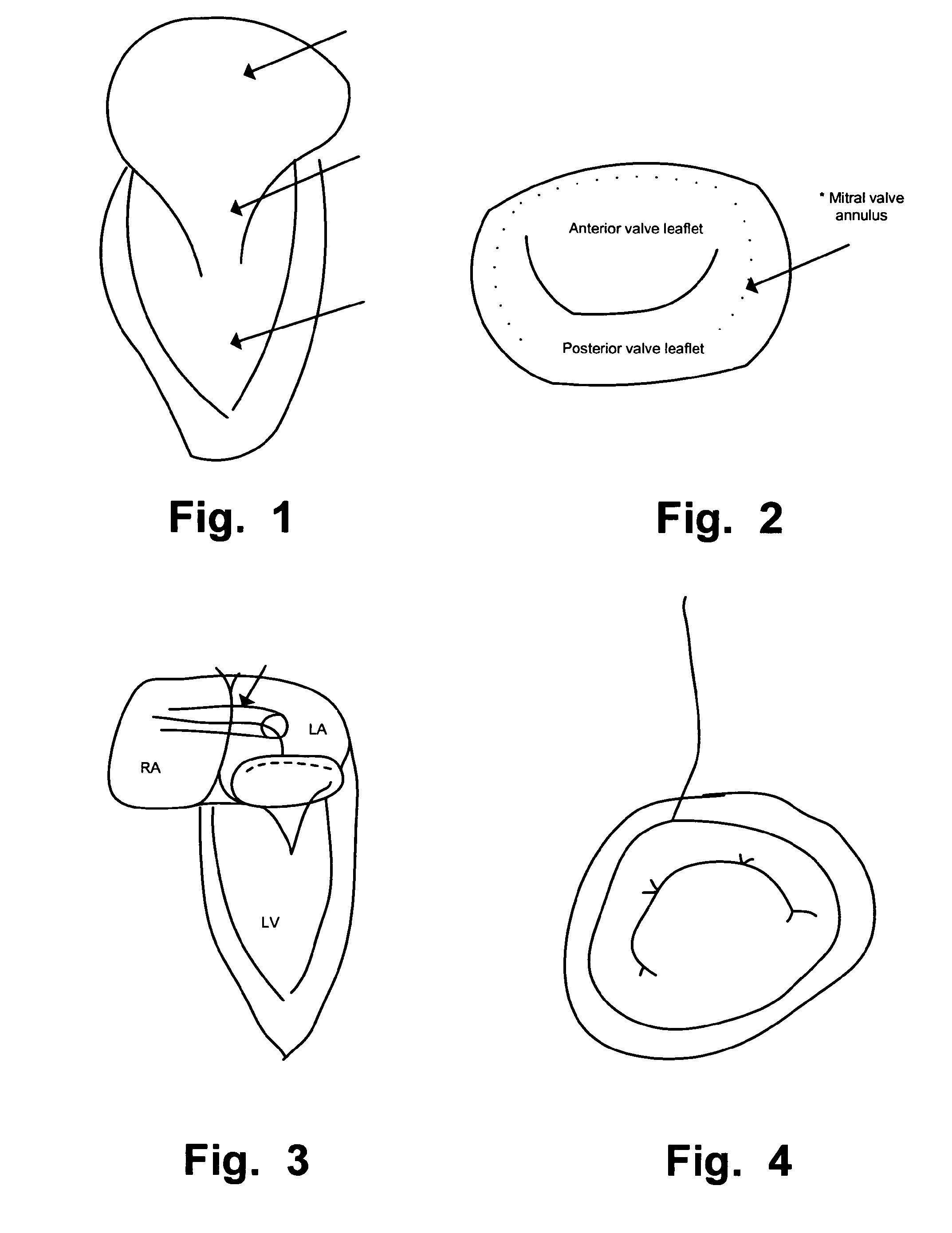 Delivery Device For Medical Implant And Medical Procedure