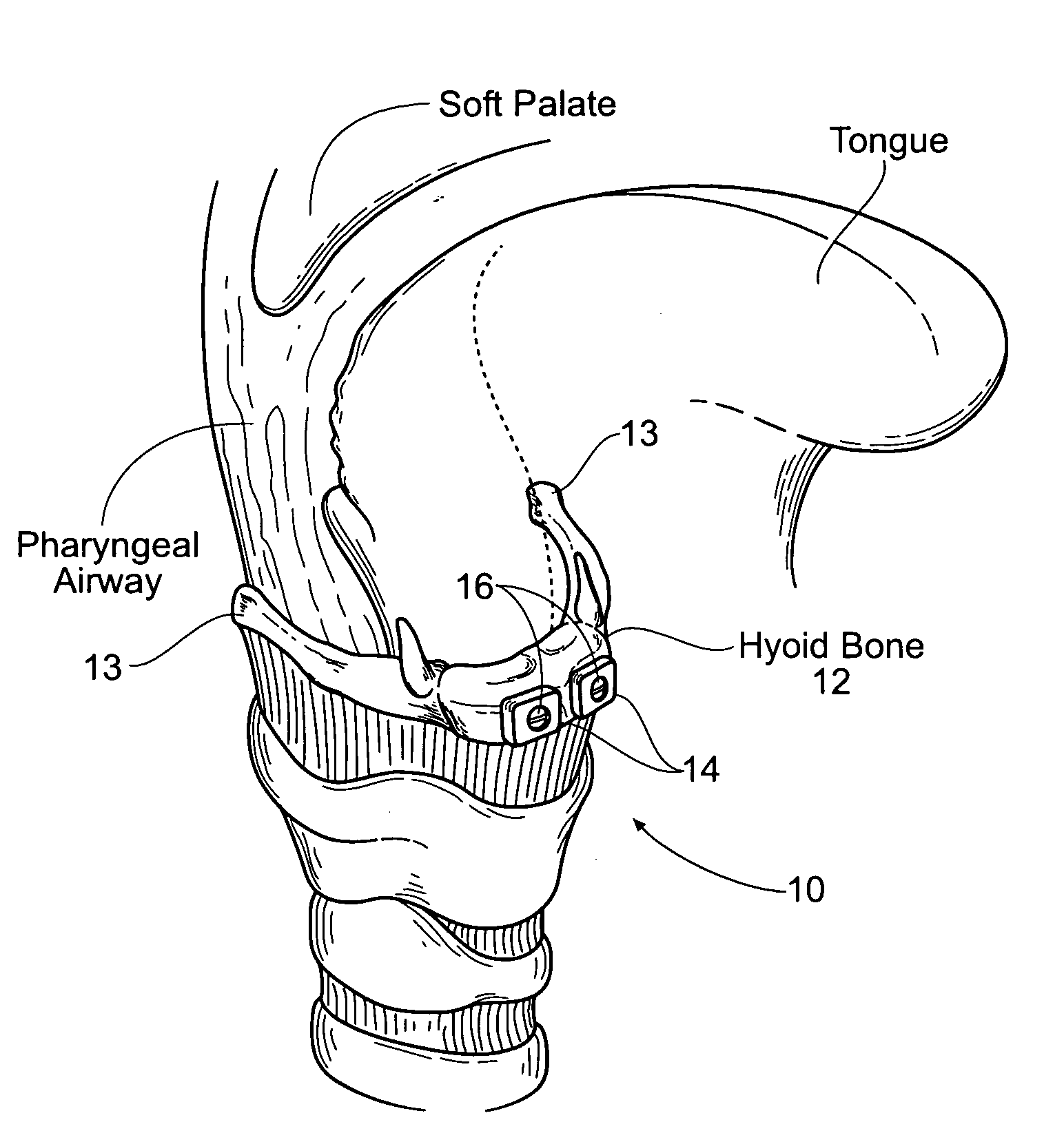 Devices, systems, and methods to move or restrain the hyoid bone
