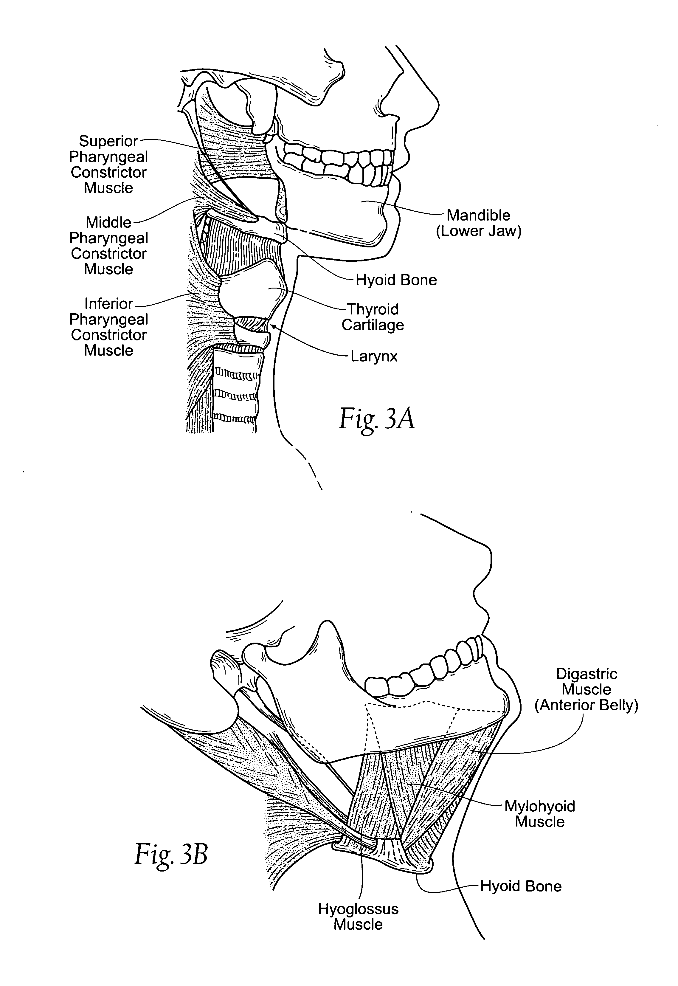 Devices, systems, and methods to move or restrain the hyoid bone