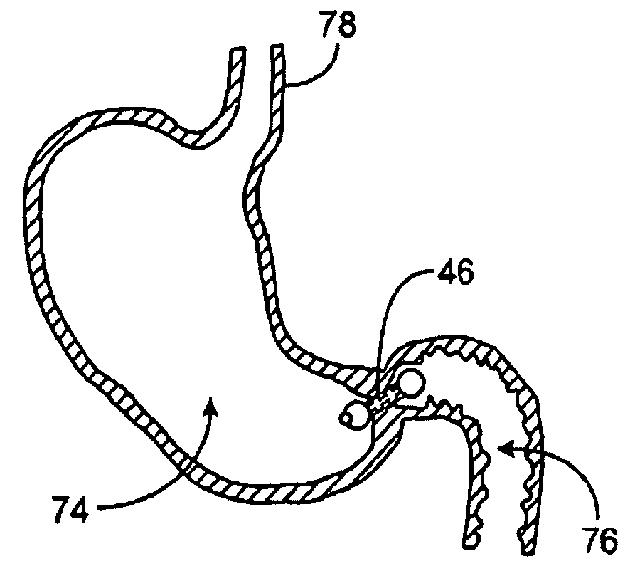 Gastric retaining devices and methods