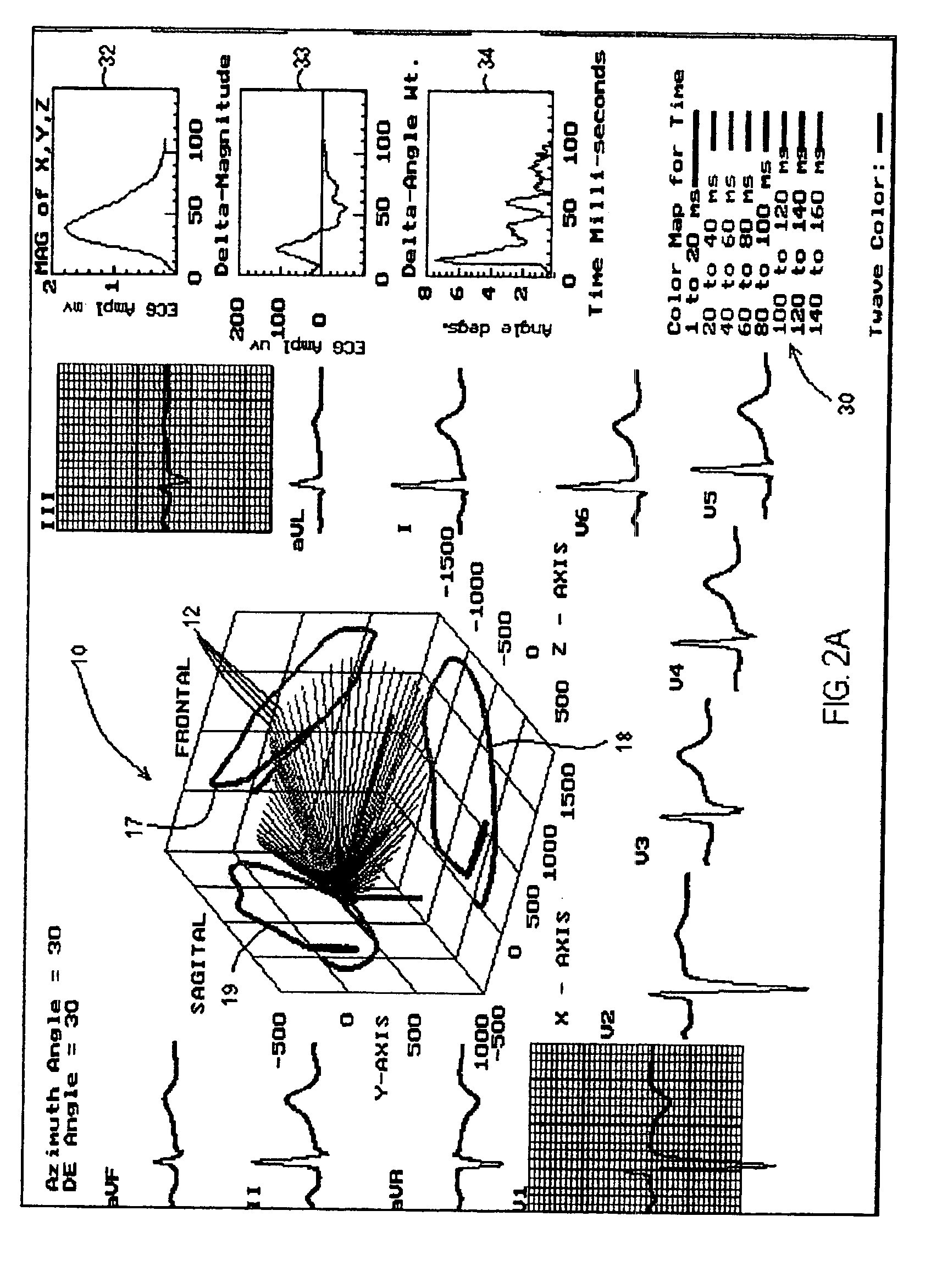 Three dimensional vector cardiograph and method for detecting and monitoring ischemic events
