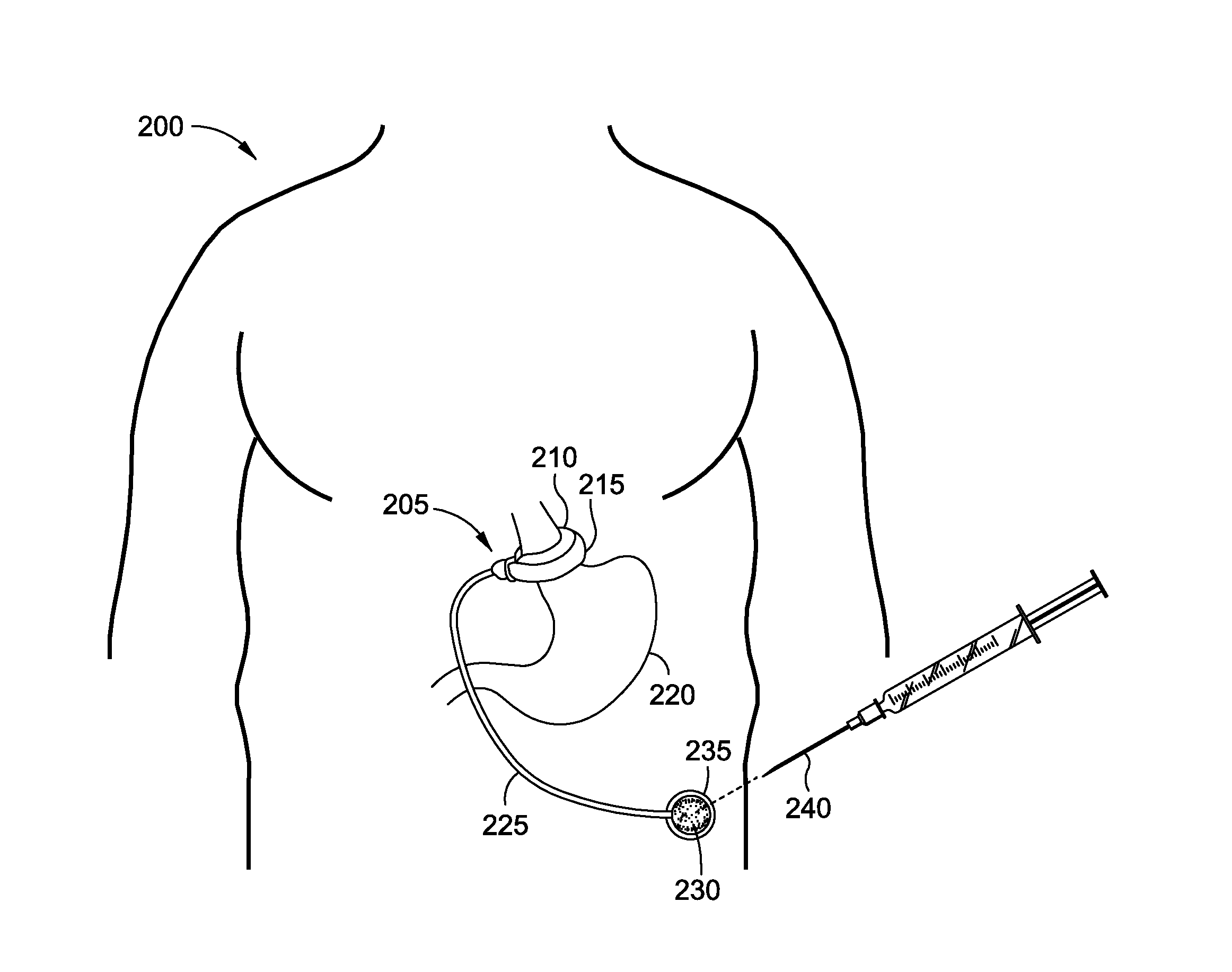 Gastric bands for reducing obstructions