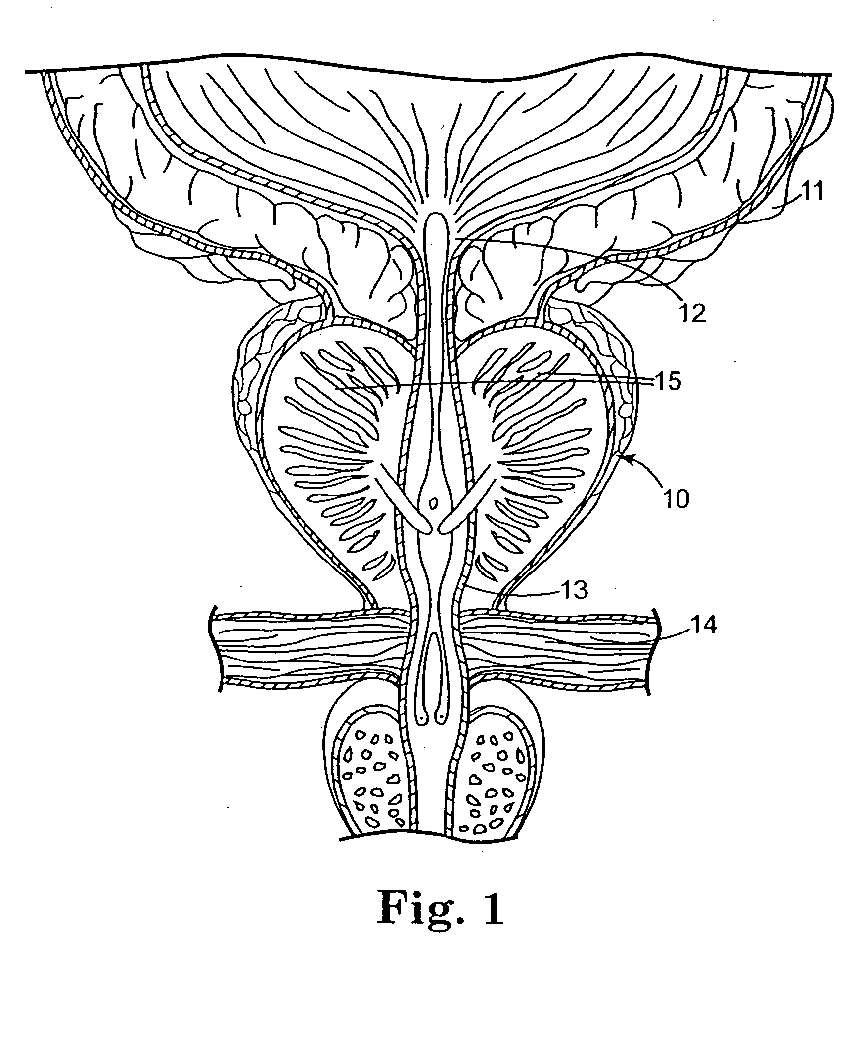 Method of injecting a drug and echogenic bubbles into prostate tissue