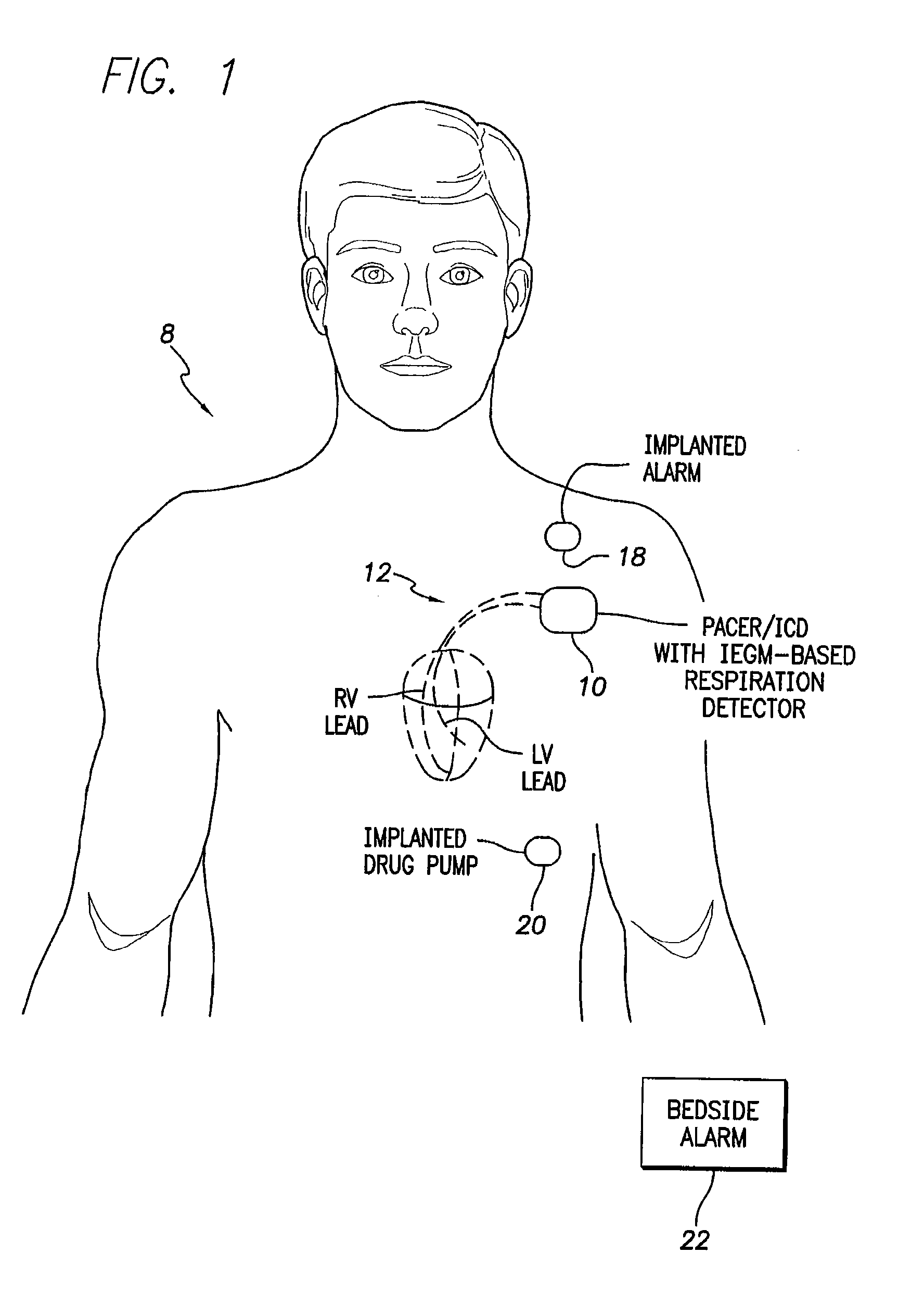 System and method for detecting abnormal respiration based on intracardiac electrogram signals using a pattern recognition device