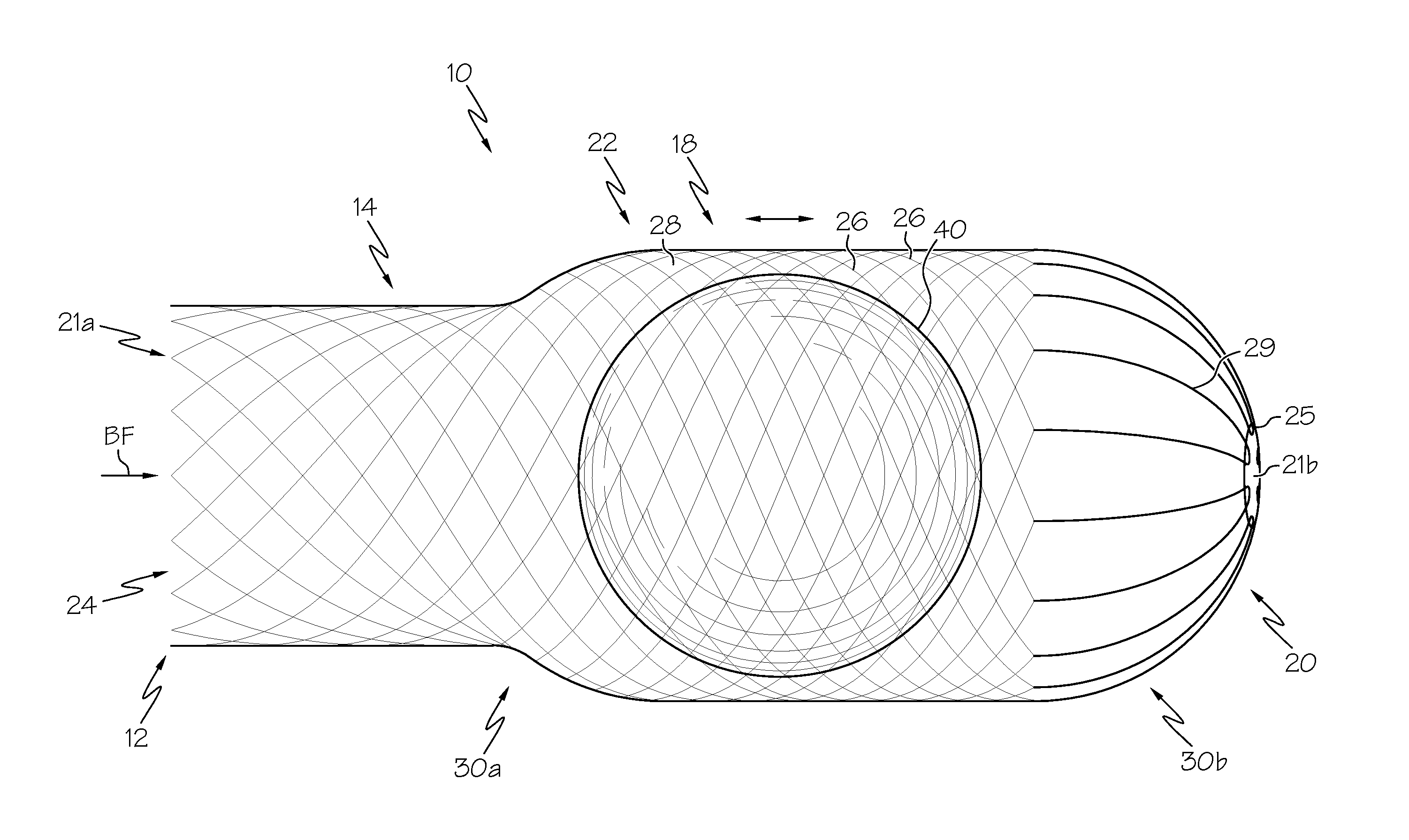 Collapsible caged-ball prosthetic valve for transcatheter delivery and method of use