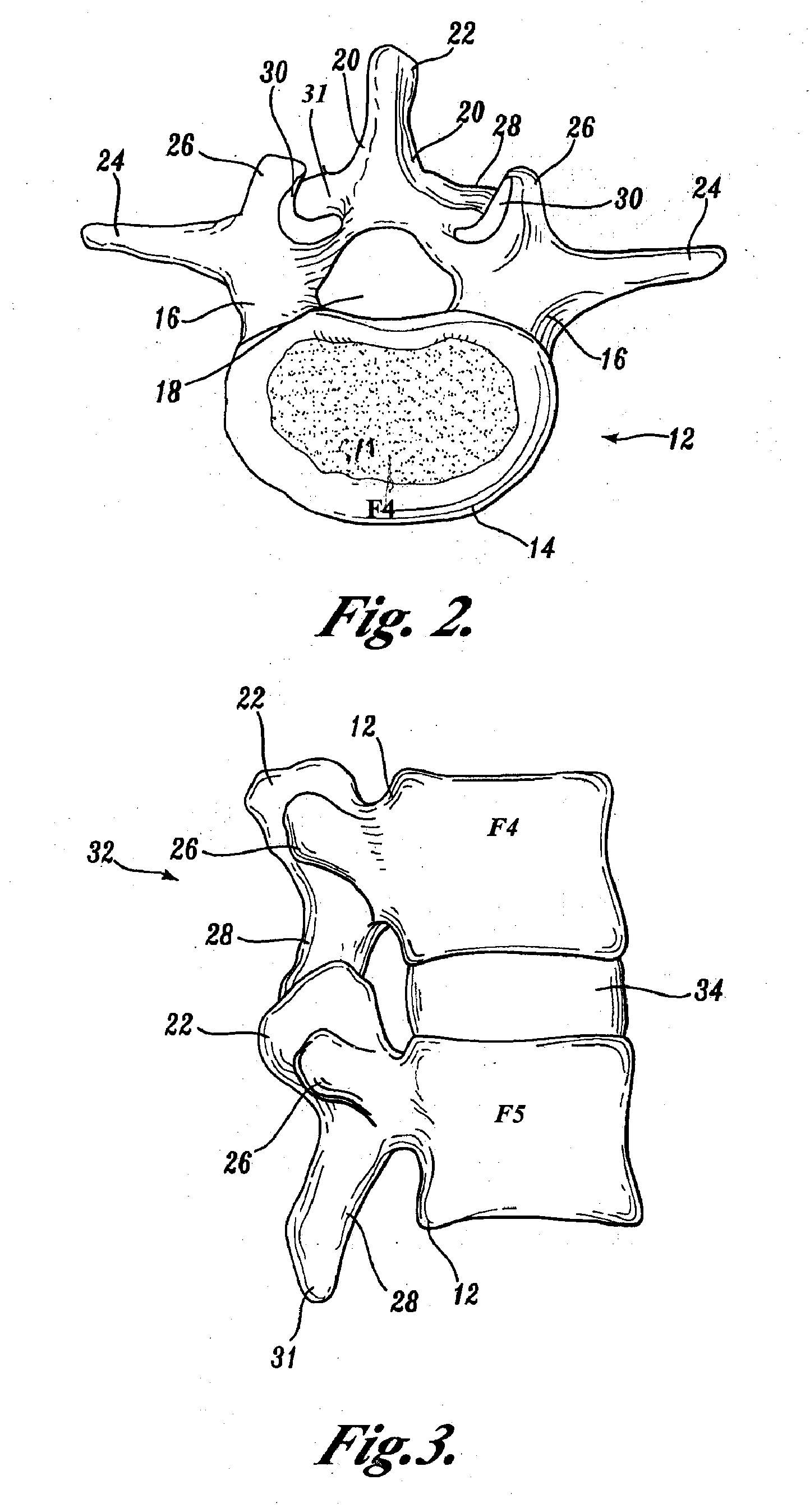 Prostheses, Tools And Methods For Replacement Of Natural Facet Joints With Artificial Facet Joint Surfaces