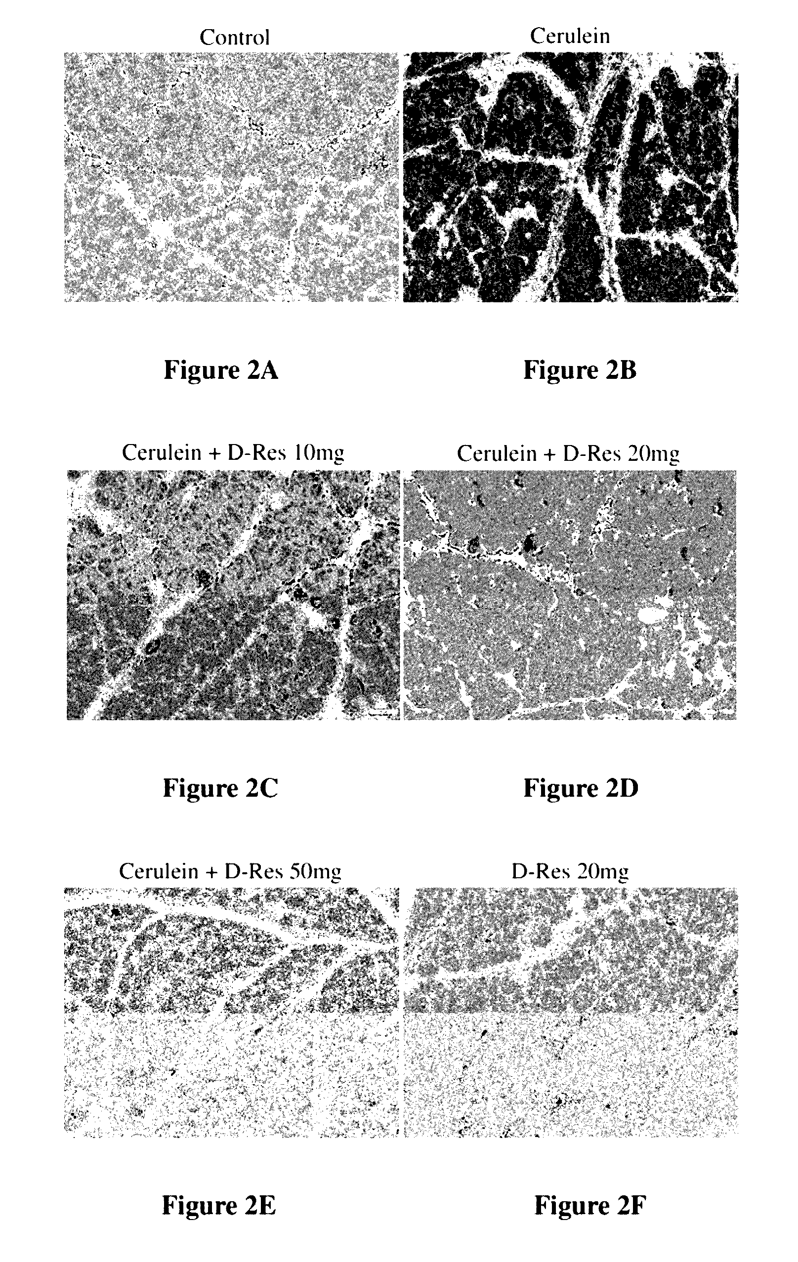 Method of using dihydro-resveratrol for treating acute pancreatitis and associated pulmonary injury