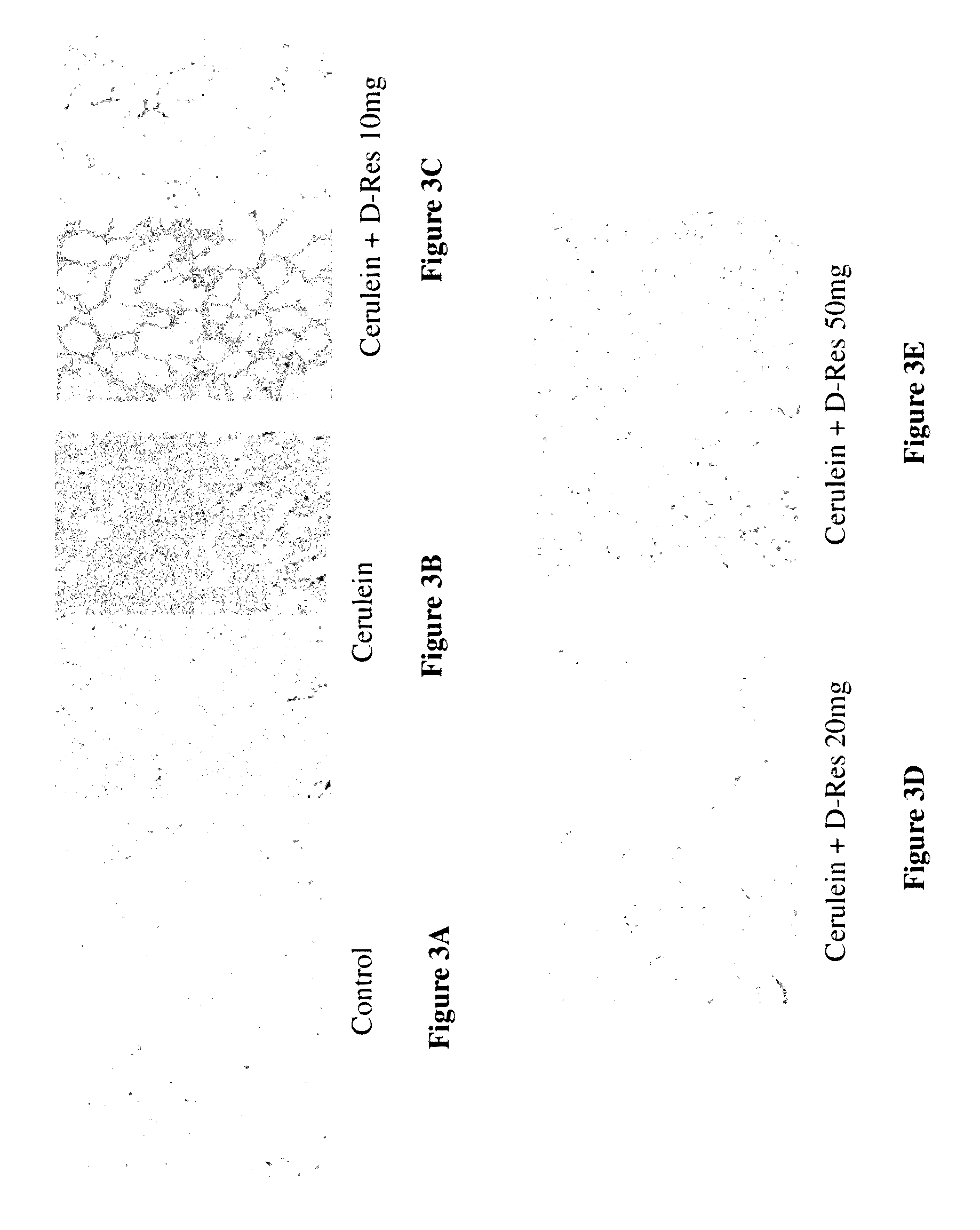 Method of using dihydro-resveratrol for treating acute pancreatitis and associated pulmonary injury