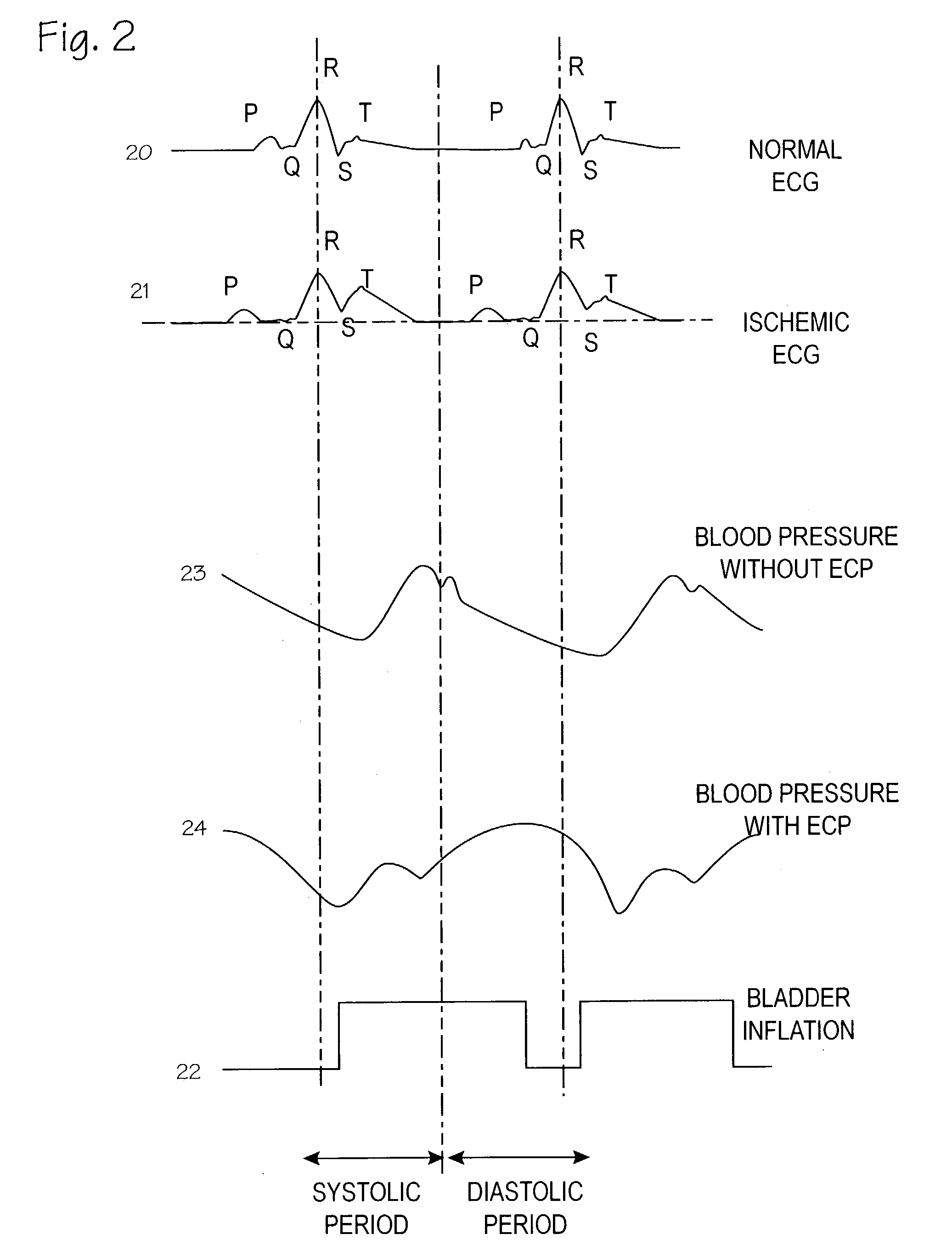 System and method for generating external counterpulsation reports