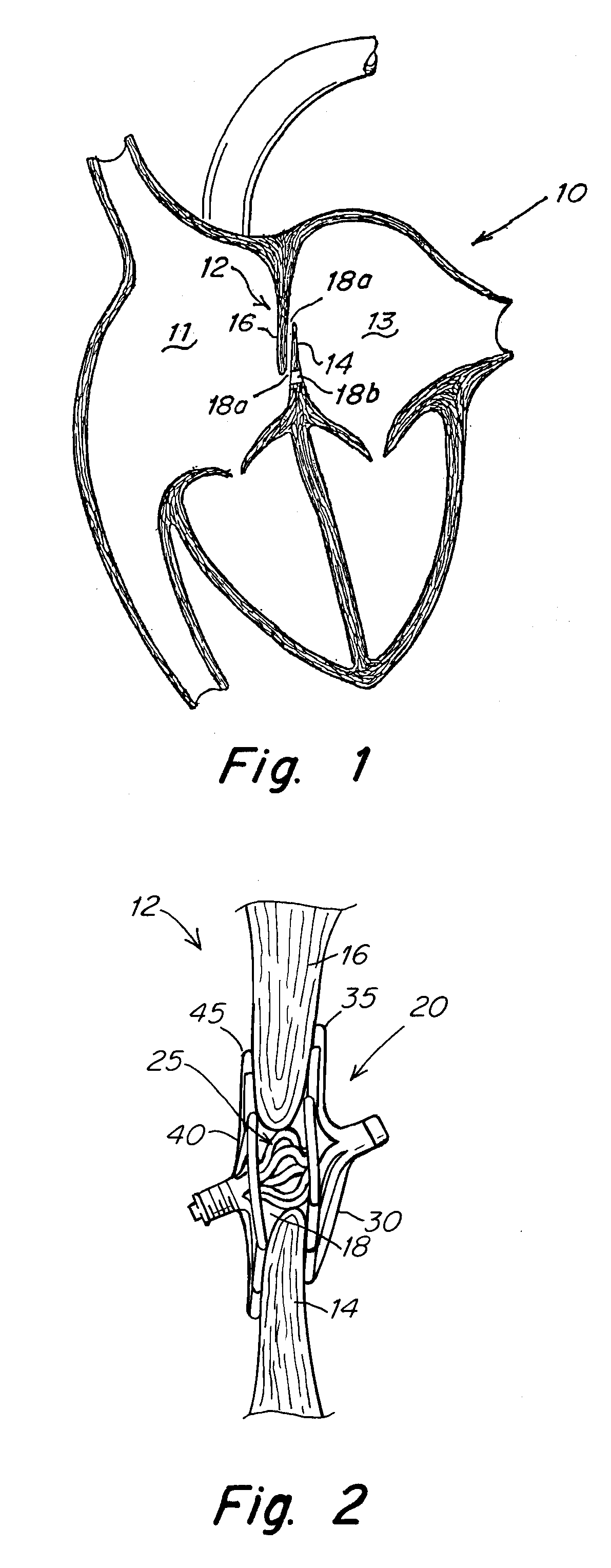 Septal closure device with centering mechanism