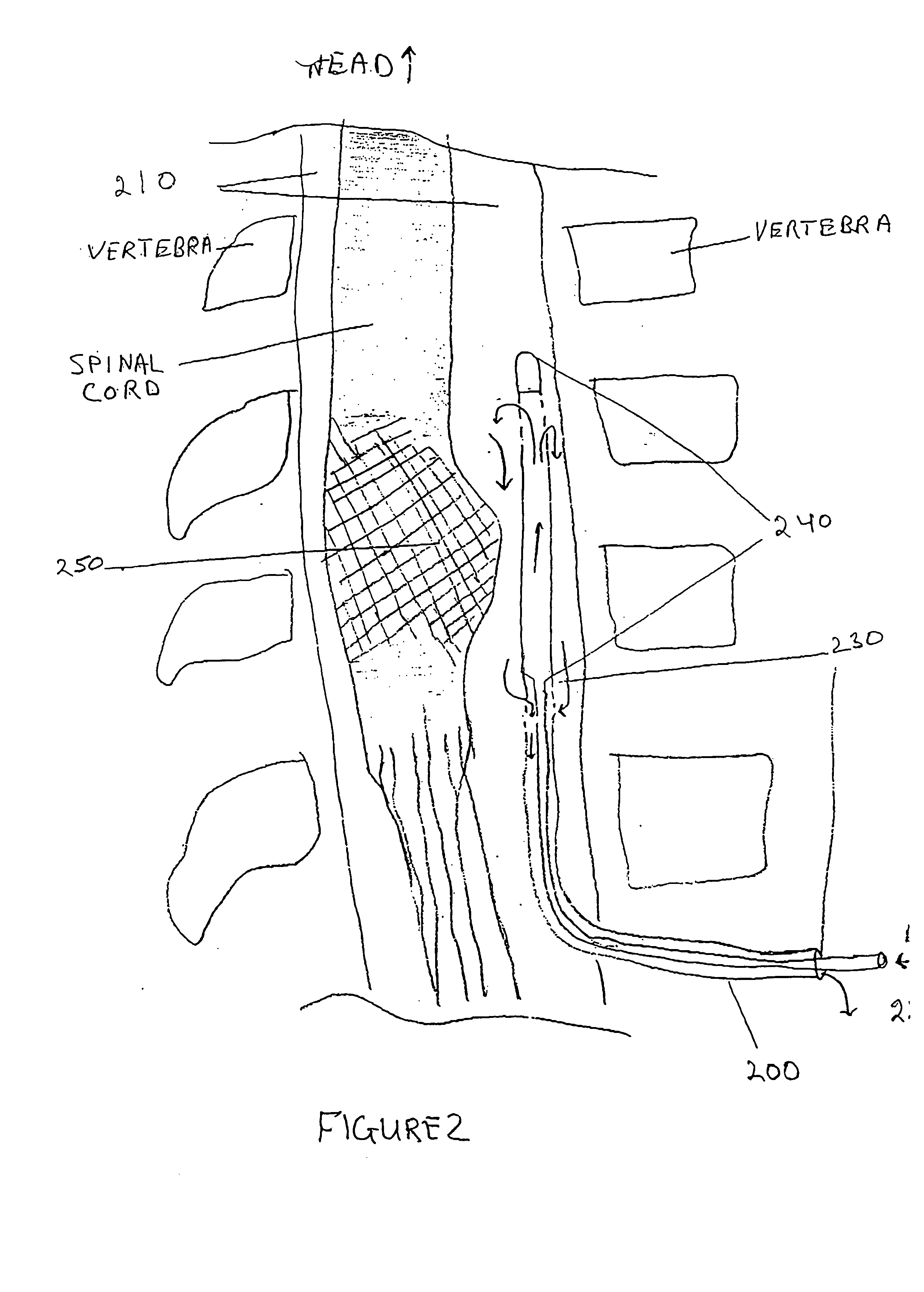 Subarachnoid spinal catheter for transporting cerebrospinal fluid