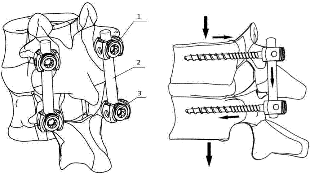 Cobalt-chromiun-molybdenum thoracolumbar posterior screw-rod system