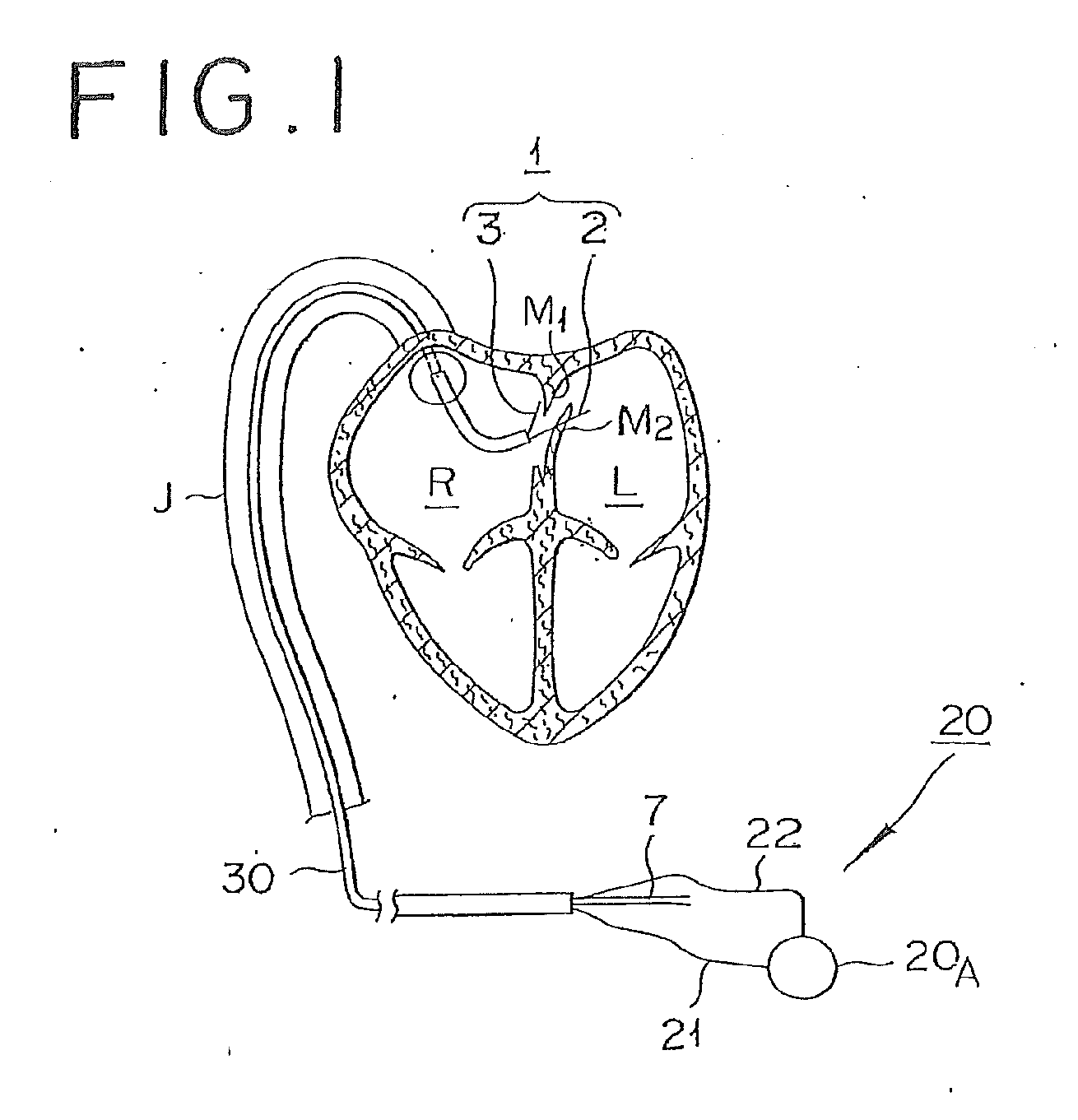 Pfo closing device