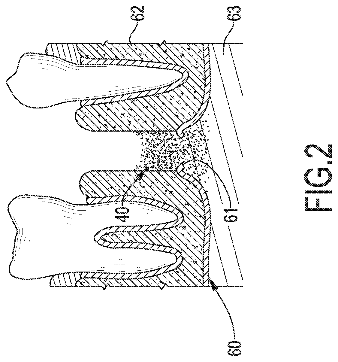 Removing Device for Dentistry