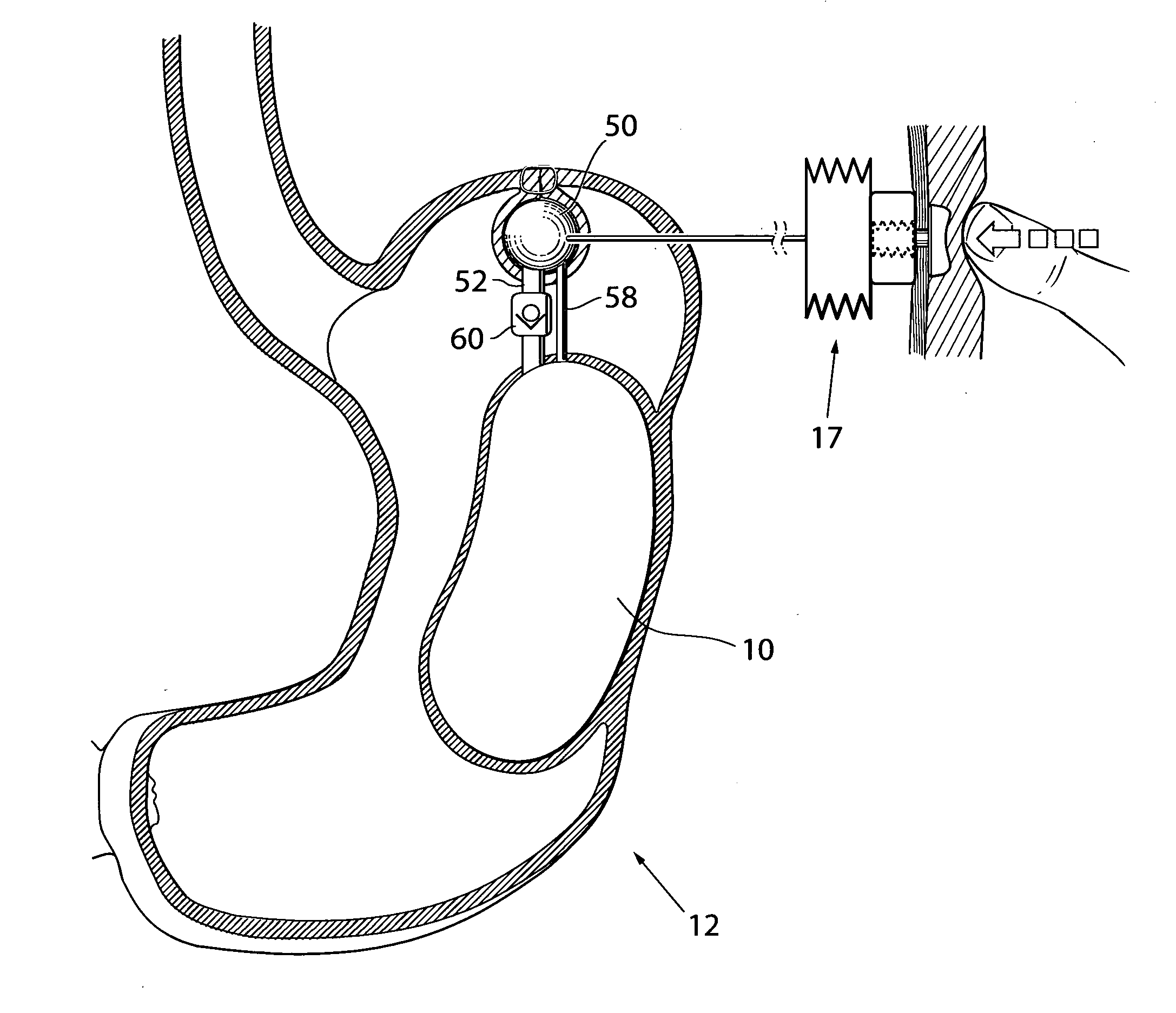 Apparatus for treating obesity