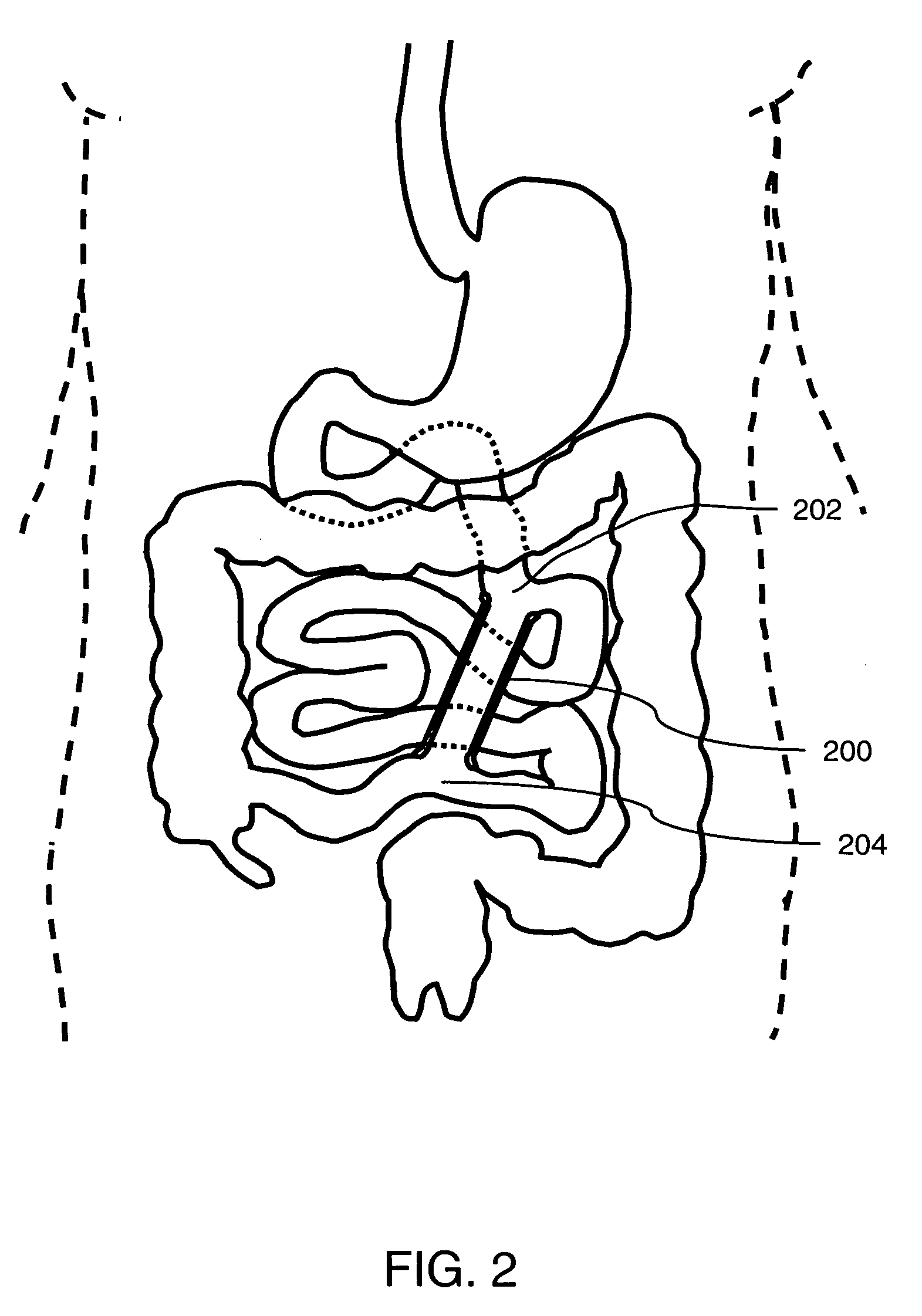 Method and device for gastrointestinal bypass