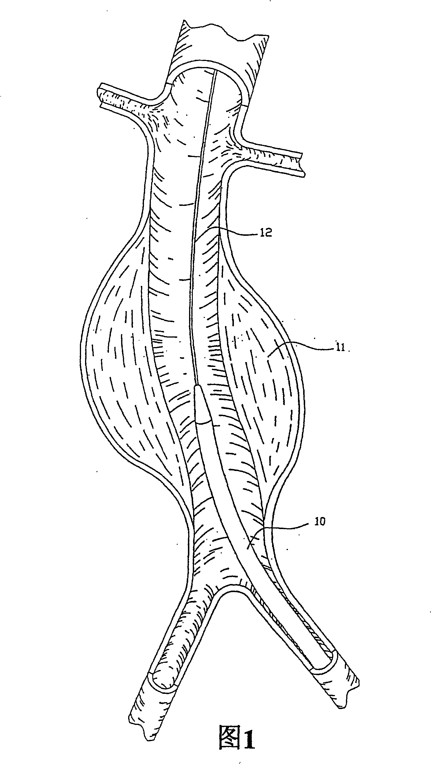 Endovascular aneurysm repair system