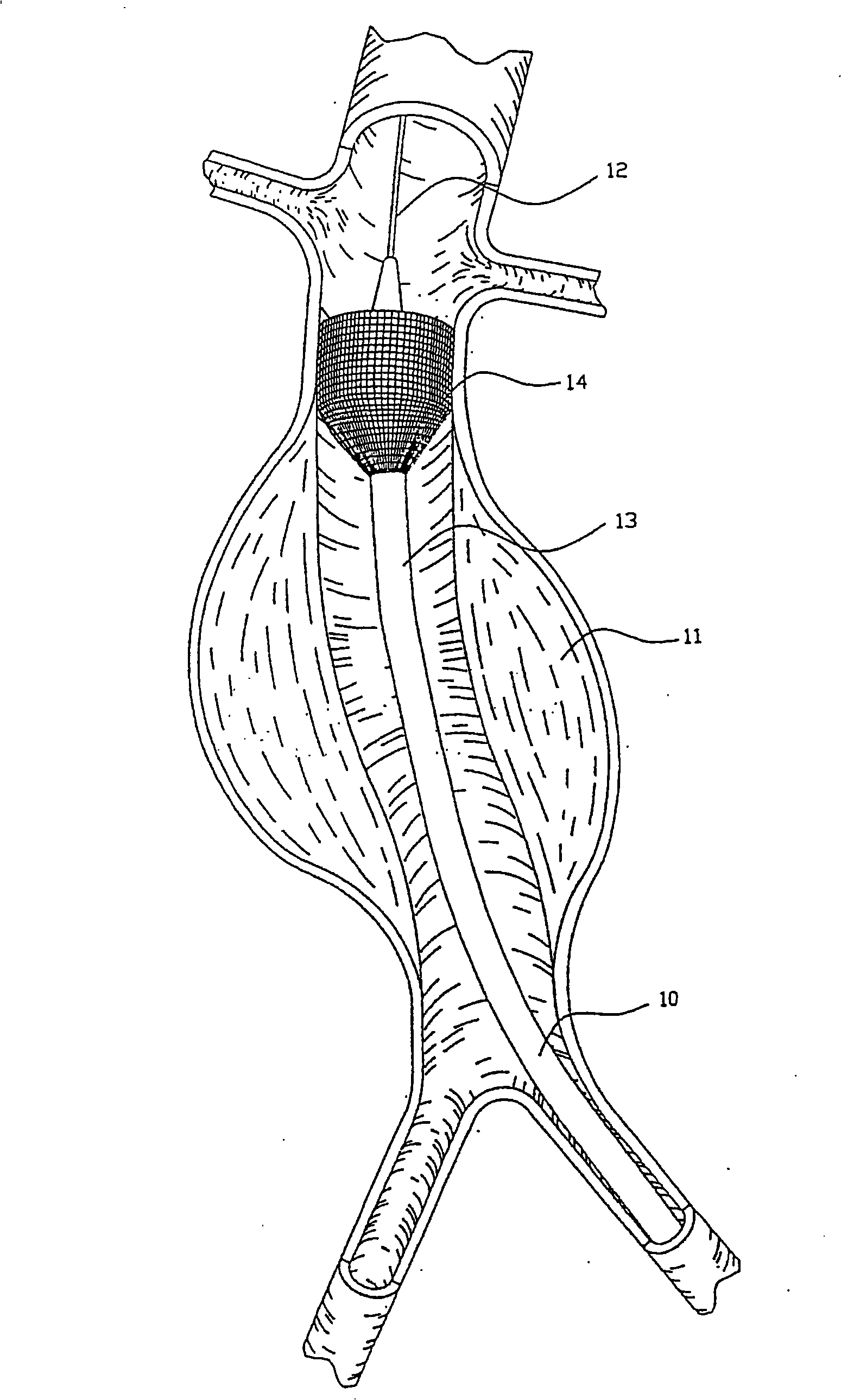 Endovascular aneurysm repair system