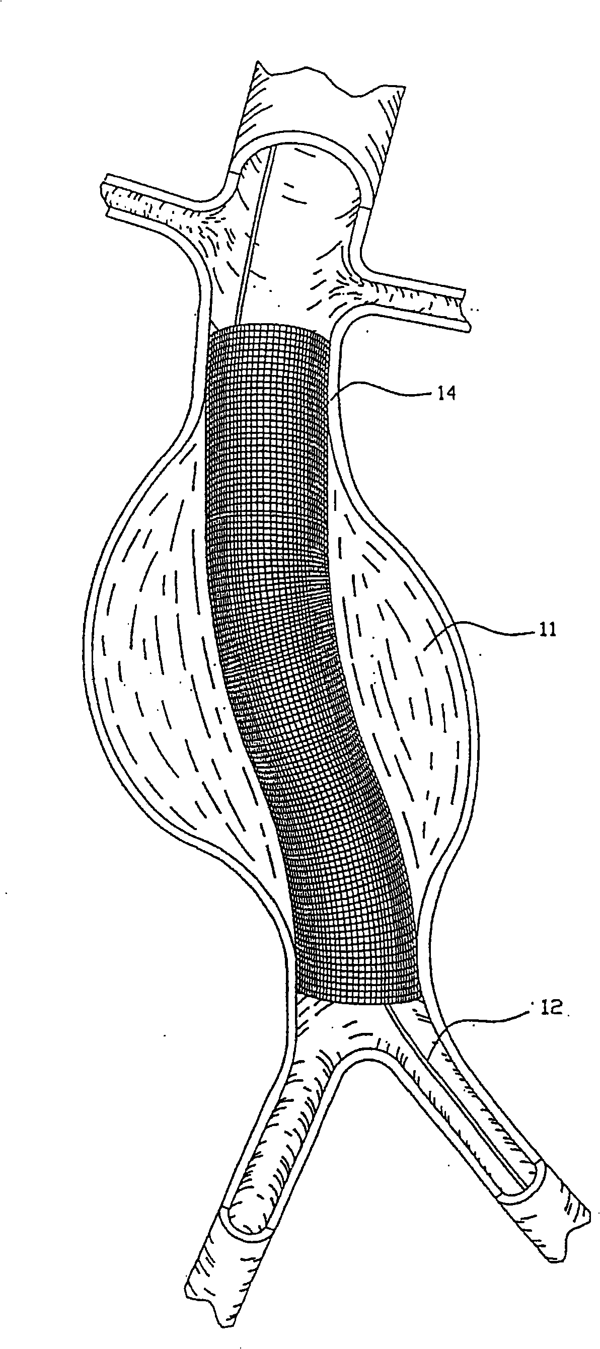 Endovascular aneurysm repair system