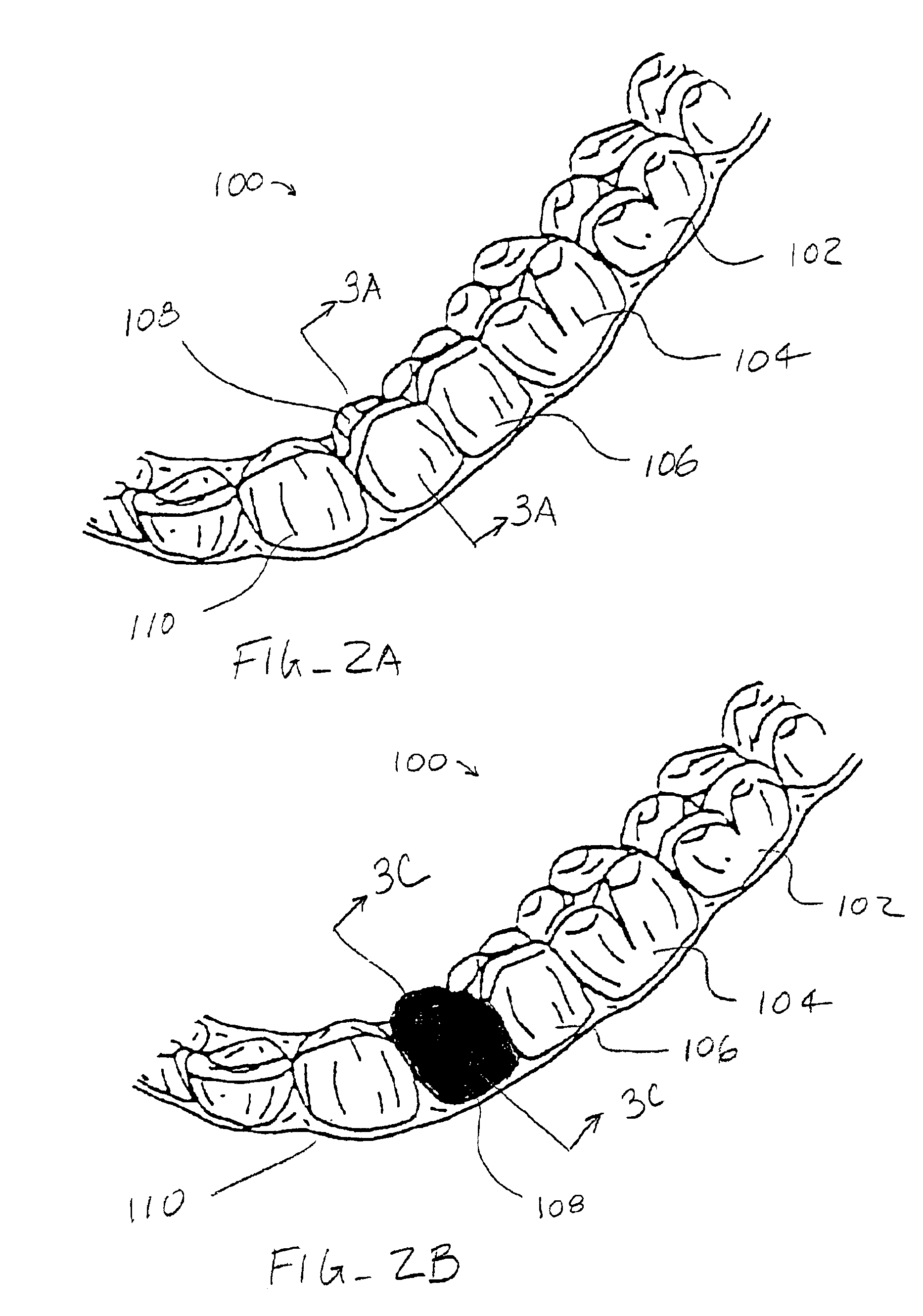Method and kits for forming pontics in polymeric shell aligners