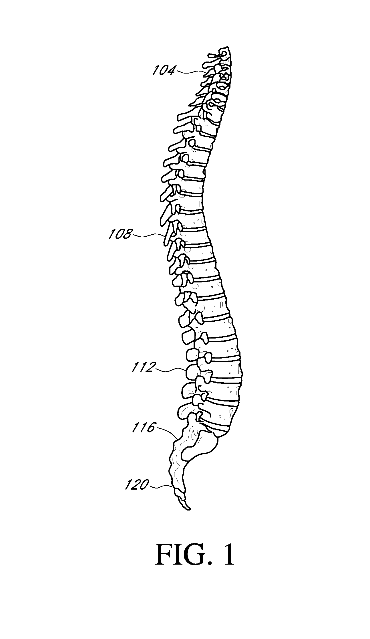 Spinal implants and implantation system