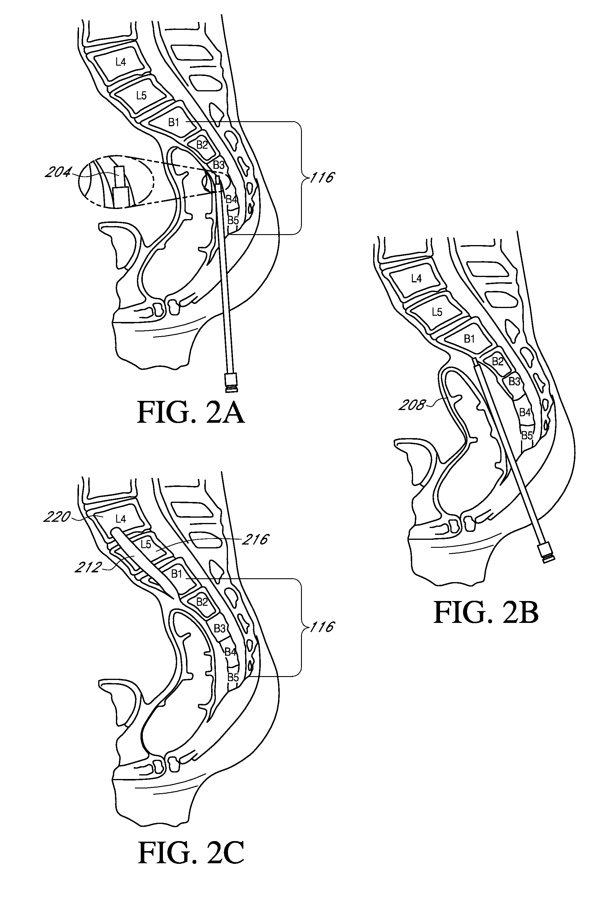 Spinal implants and implantation system