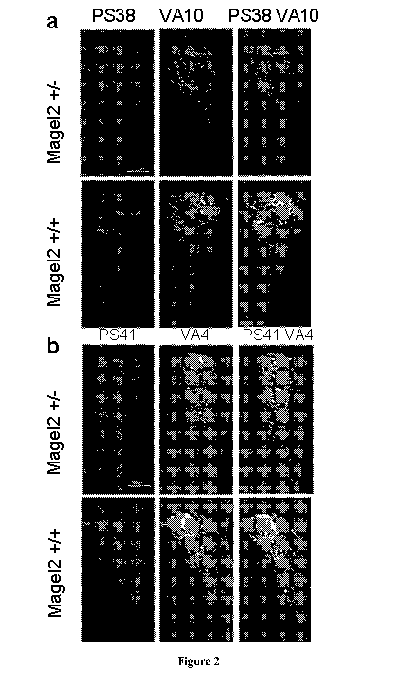 Methods and Pharmaceutical Composition for the Treatment of a Feeding Disorder with Early-Onset in a Patient