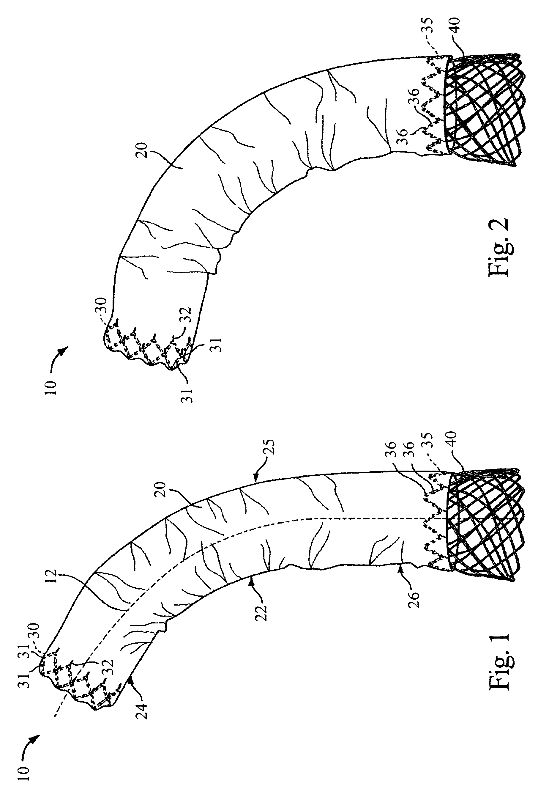 Stent Graft Delivery System for Accurate Deployment