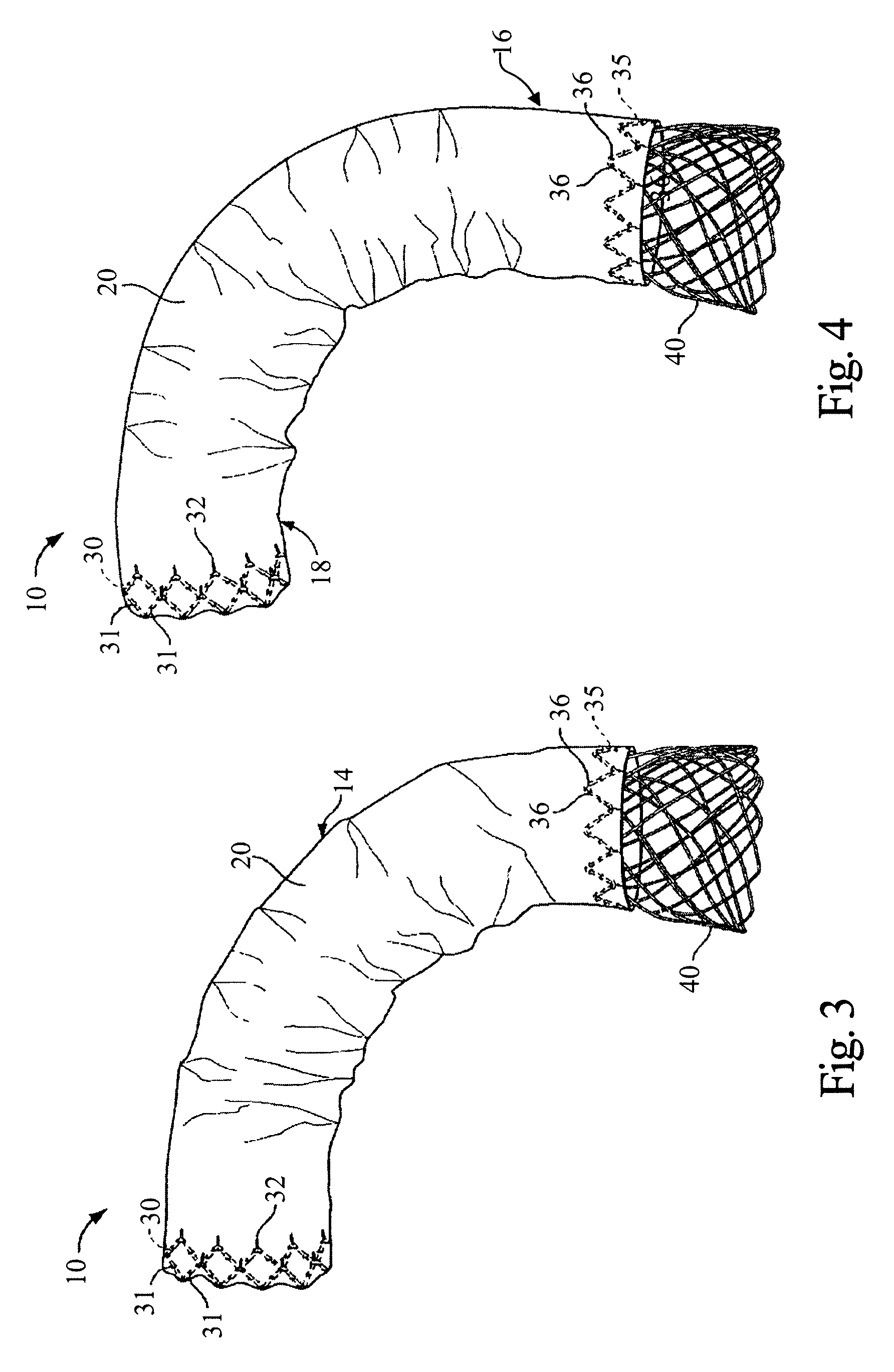 Stent Graft Delivery System for Accurate Deployment