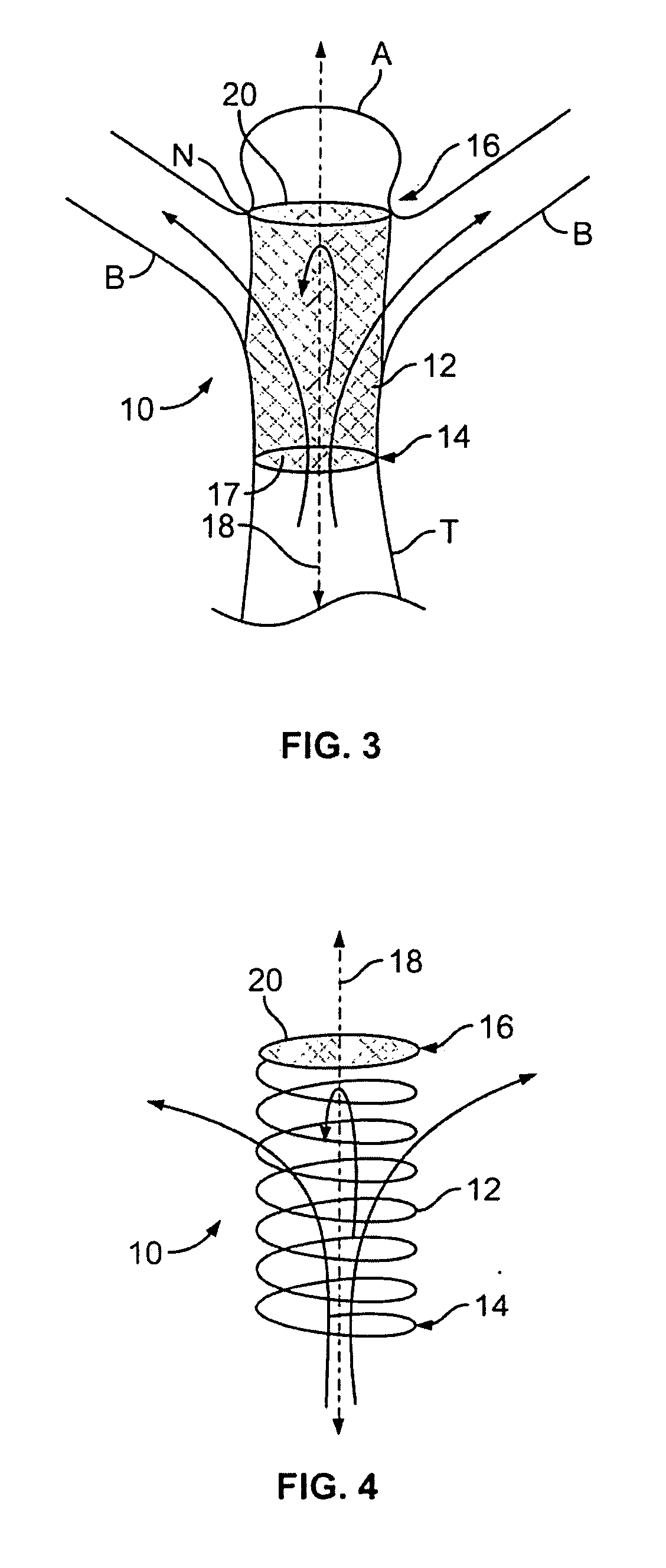 Isolation devices for the treatment of aneurysms