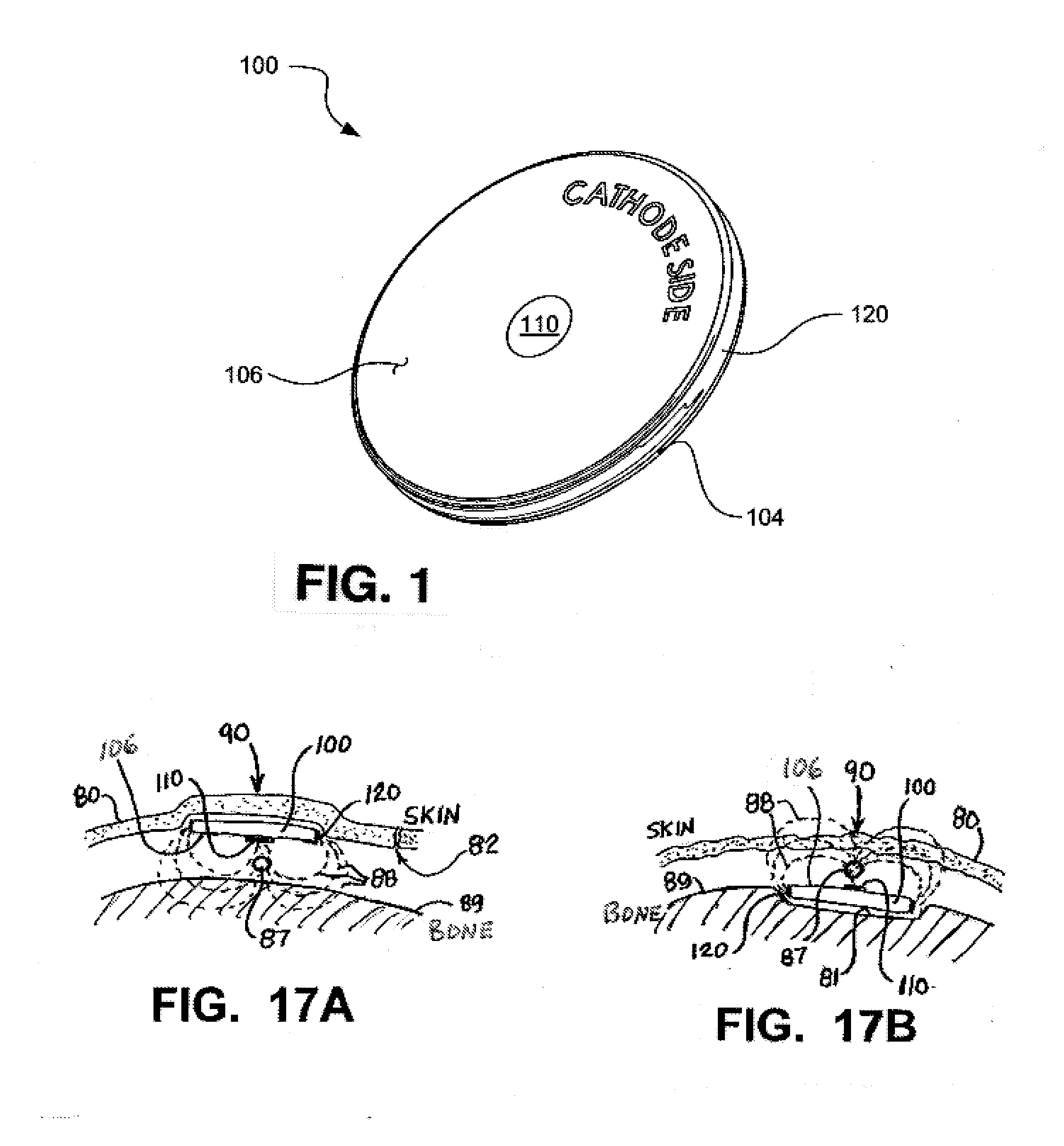 Implantable Electroacupuncture Device