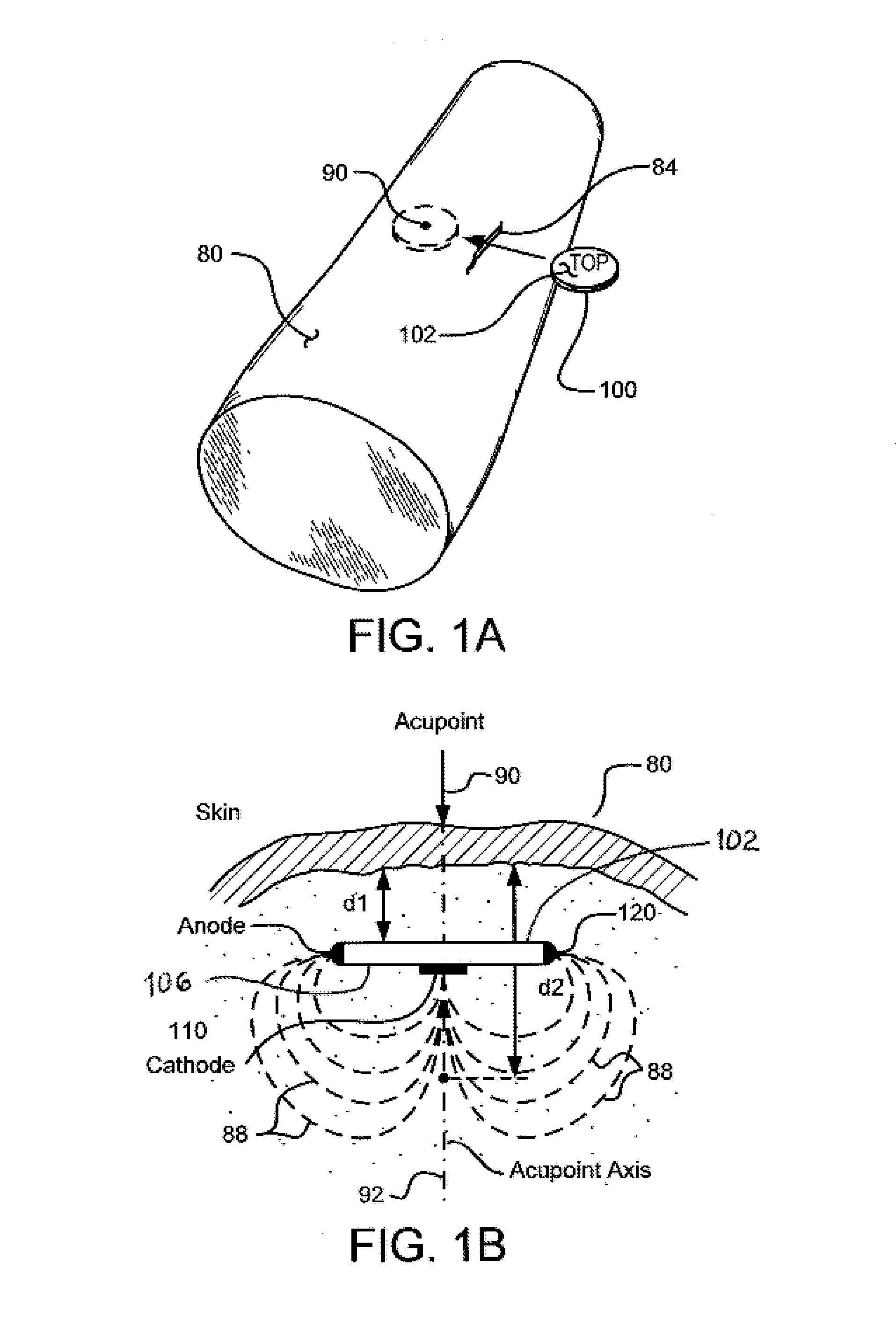 Implantable Electroacupuncture Device