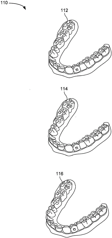Segmented orthodontic appliance with elastics