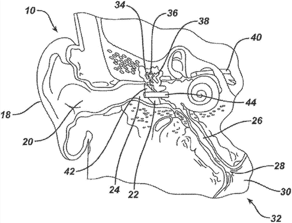 Low profile eustachian tube dilation system