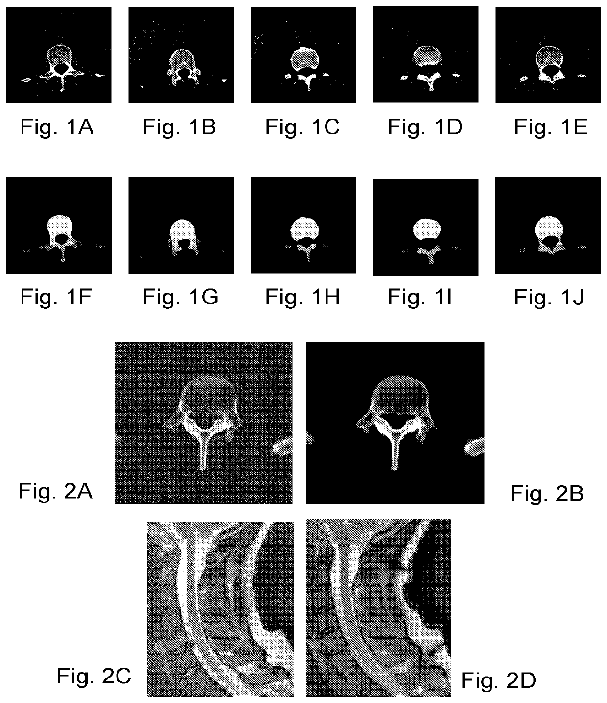 Automated segmentation of three dimensional bony structure images