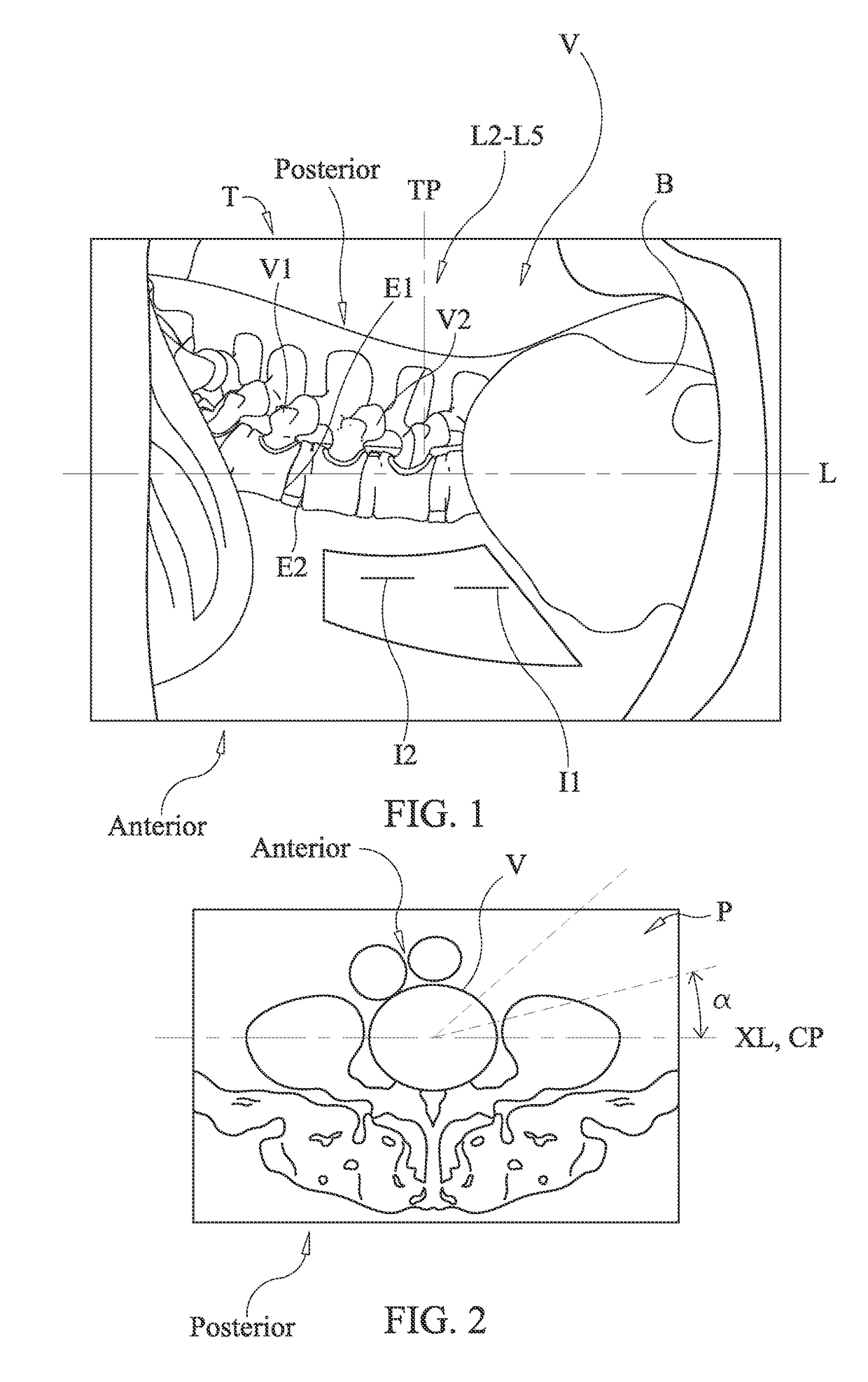 Spinal implant system and method