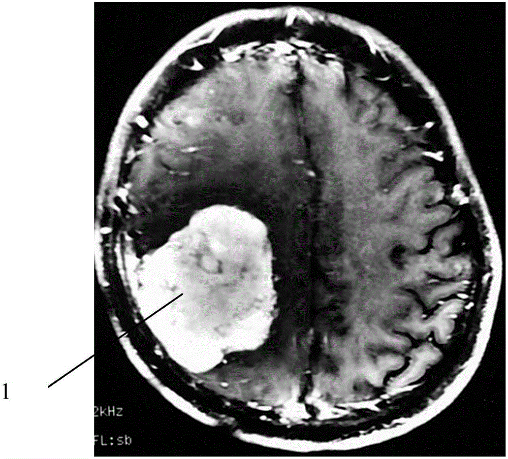 Integral resection method of huge and super huge meningioma