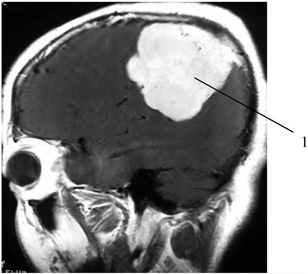 Integral resection method of huge and super huge meningioma