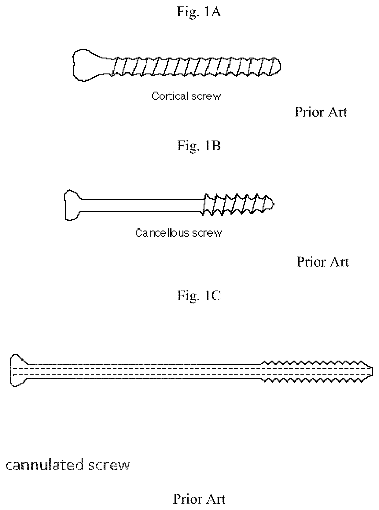 One Step Surgical Screw Fixation Technique and Design