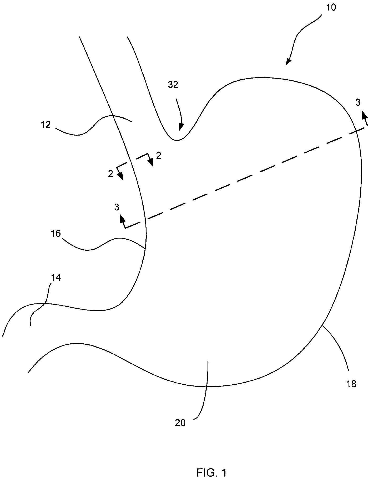 Device and method for endoluminal therapy