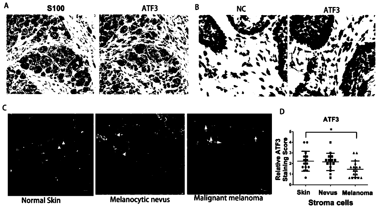 Applications of dermal fibroblasts in treating melanomas
