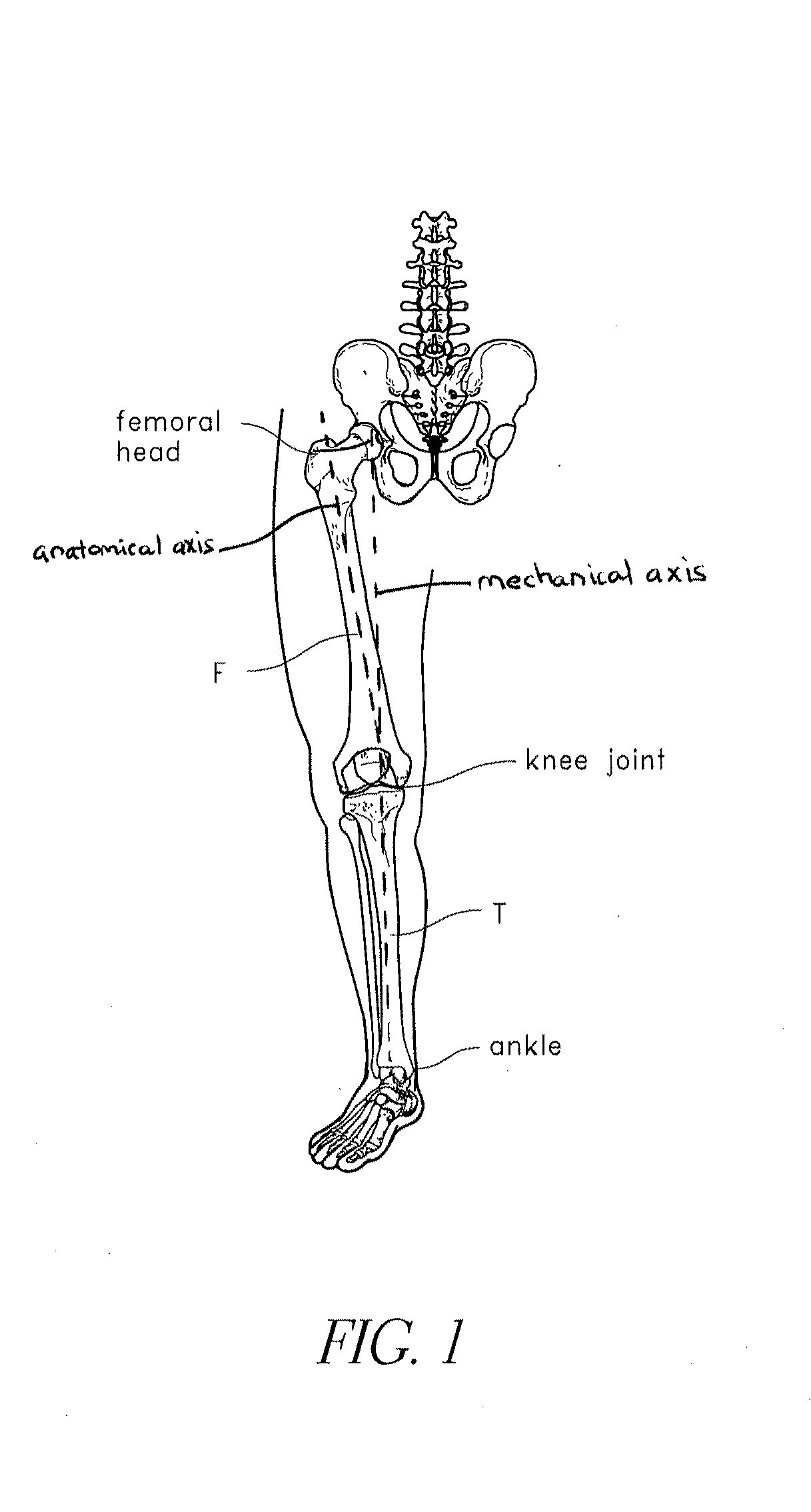Systems and methods for joint replacement