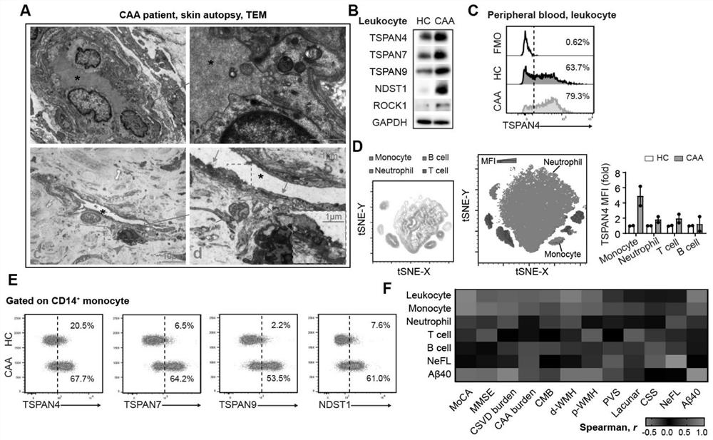 Application of macrophage migration body as cerebral amyloid vascular disease treatment target