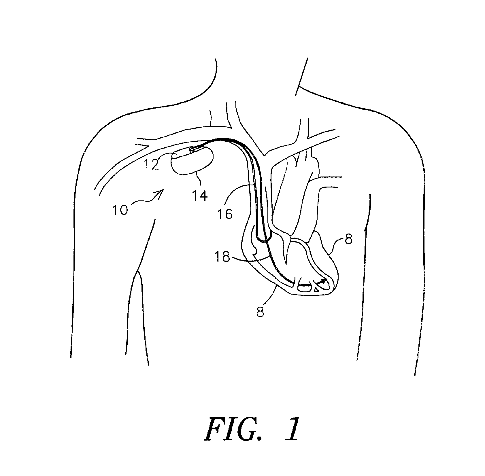 Methods for adjusting cardiac detection criteria and implantable medical devices using same