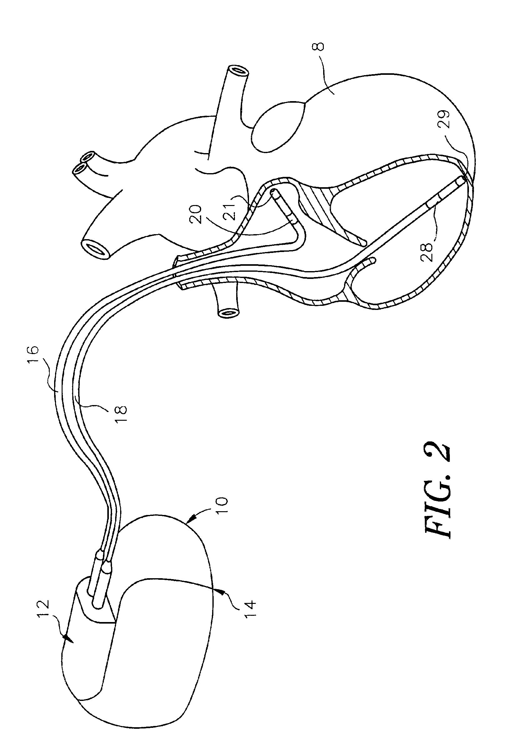 Methods for adjusting cardiac detection criteria and implantable medical devices using same