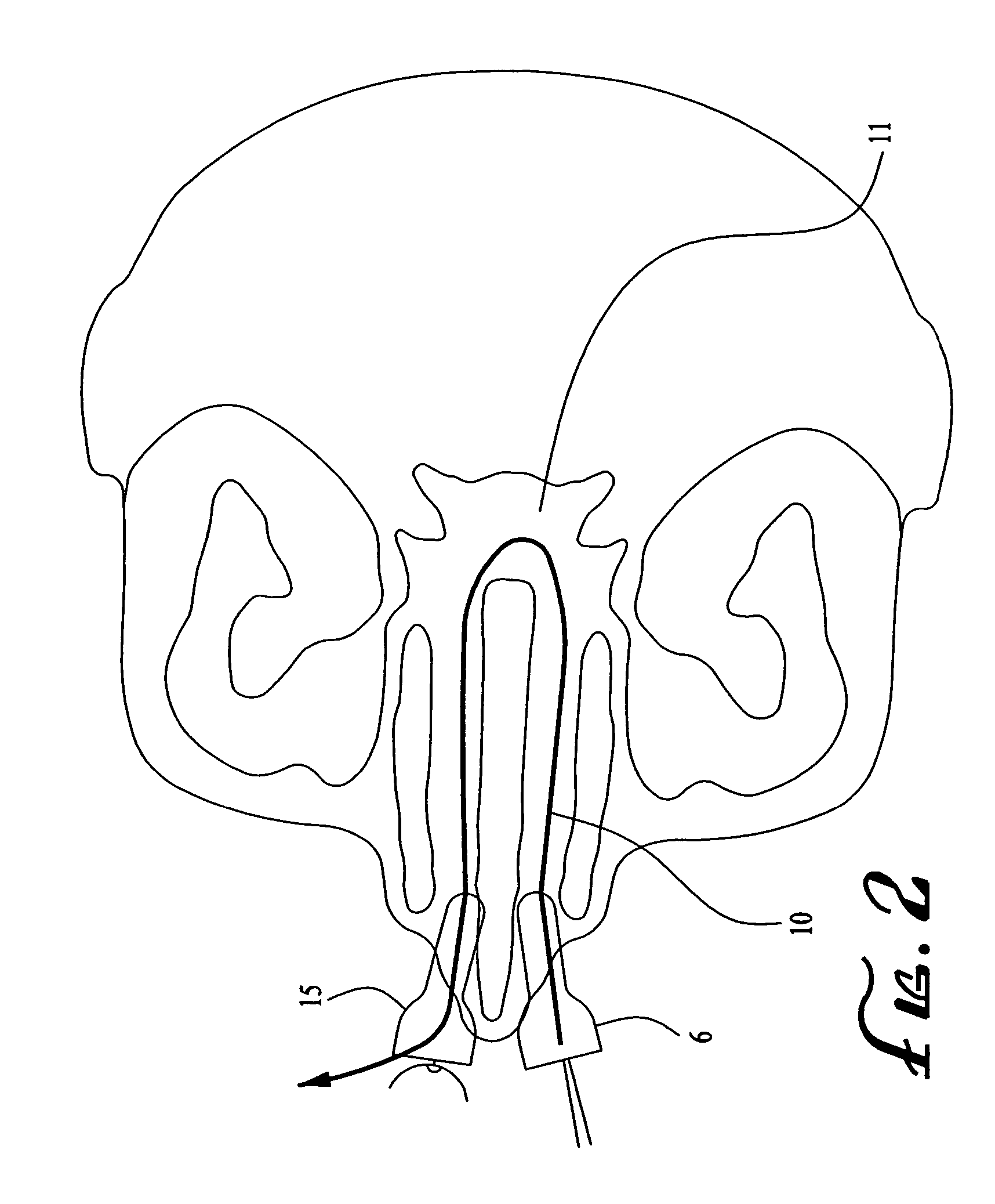 Nitric oxide decontamination of the upper respiratory tract